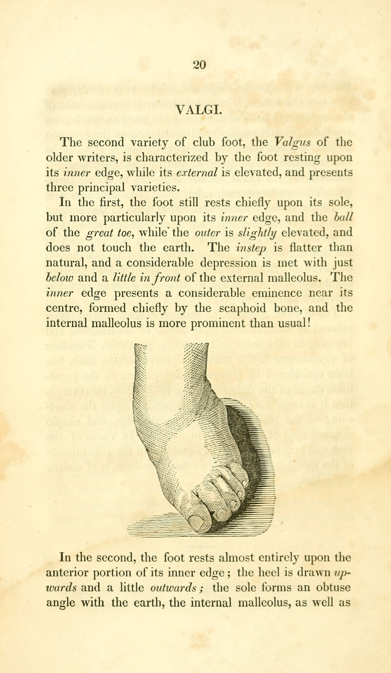 VALGI. The second variety of club foot, the Valgus of the older writers, is characterized by the foot resting upon its inner edge, while its external is elevated, and presents three principal varieties. In the first, the foot still rests chiefly upon its sole, but more particularly upon its inner edge, and the ball of the great toe, while* the outer is slightly elevated, and does not touch the earth. The instep is flatter than natural, and a considerable depression is met with just below and a little in front of the external malleolus. The inner edge presents a considerable eminence near its centre, formed chiefly by the scaphoid bone, and the internal malleolus is more prominent than usual! In the second, the foot rests almost entirely upon the anterior portion of its inner edge; the heel is drawn up- wards and a little outwards; the sole forms an obtuse angle with the earth, the internal malleolus, as well as