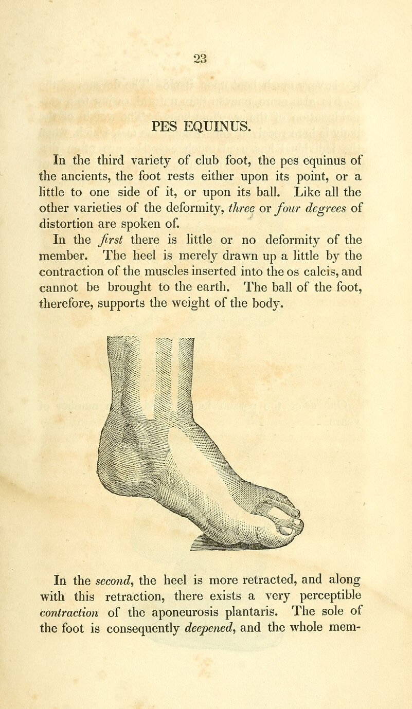 PES EQUINUS. In the third variety of club foot, the pes equinus of the ancients, the foot rests either upon its point, or a little to one side of it, or upon its ball. Like all the other varieties of the deformity, three or four degrees of distortion are spoken of. In the first there is little or no deformity of the member. The heel is merely drawn up a little by the contraction of the muscles inserted into the os calcis, and cannot be brought to the earth. The ball of the foot, therefore, supports the weight of the body. In the second, the heel is more retracted, and along with this retraction, there exists a very perceptible contraction of the aponeurosis plantaris. The sole of the foot is consequently deepened, and the whole mem-