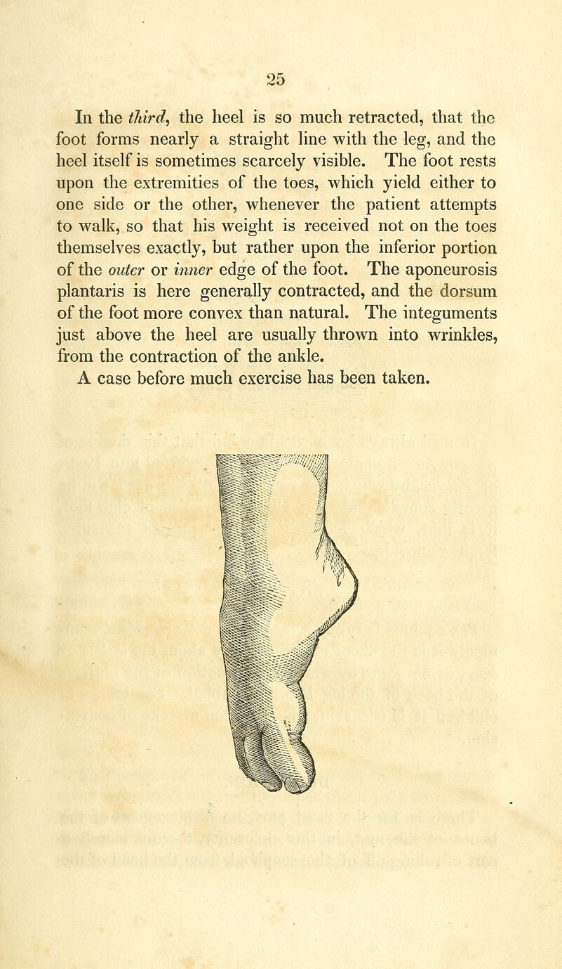 In the third, the heel is so much retracted, that the foot forms nearly a straight line with the leg, and the heel itself is sometimes scarcely visible. The foot rests upon the extremities of the toes, which yield either to one side or the other, whenever the patient attempts to walk, so that his weight is received not on the toes themselves exactly, but rather upon the inferior portion of the outer or inner edge of the foot. The aponeurosis plantaris is here generally contracted, and the dorsum of the foot more convex than natural. The integuments just above the heel are usually thrown into wrinkles, from the contraction of the ankle. A case before much exercise has been taken.