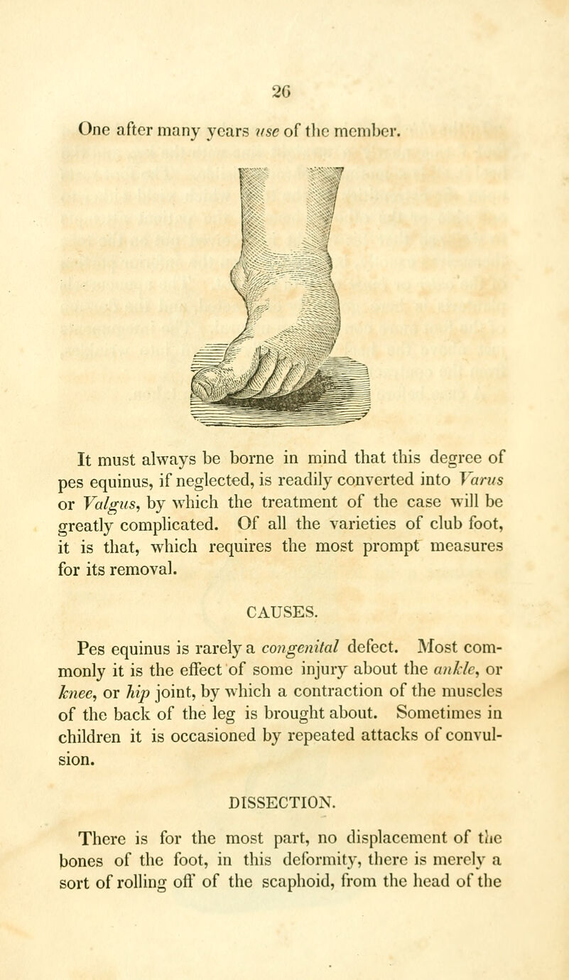 2G One after many years use of the member, It must always be borne in mind that this degree of pes equinus, if neglected, is readily converted into Varus or Valgus, by which the treatment of the case will be greatly complicated. Of all the varieties of club foot, it is that, which requires the most prompt measures for its removal. CAUSES. Pes equinus is rarely a congenital defect. Most com- monly it is the effect of some injury about the ankle, or knee, or hip joint, by which a contraction of the muscles of the back of the leg is brought about. Sometimes in children it is occasioned by repeated attacks of convul- sion. DISSECTION. There is for the most part, no displacement of the bones of the foot, in this deformity, there is merely a sort of rolling oft' of the scaphoid, from the head of the