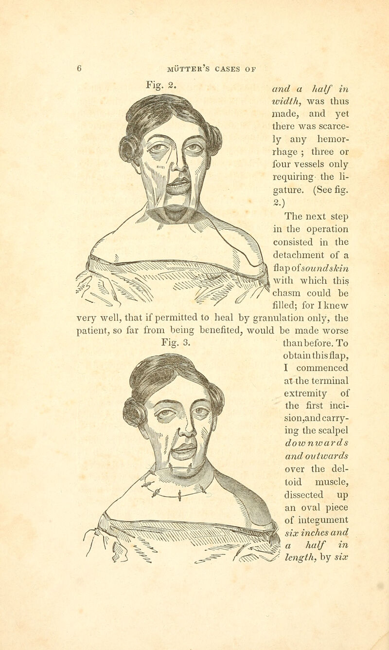 and a half in width, was thus made, and yet there was scarce- ly any hemor- rhage ; three or four vessels only requiring- the li- gature. (See fig. 2.) The next step in the operation coDsisted in the detachment of a flap of sound skin with which this chasm could be filled; for I knew very well, that if permitted to heal by granulation only, the patient, so far from being benefited, would be made worse Fig. 3. than before. To obtain this flap, I commenced at the terminal extremity of the first inci- sion,and carry- ing the scalpel downwards and outwards over the del- toid muscle, dissected up an oval piece of integument six inches and ^W: a half in >^y- length, by six