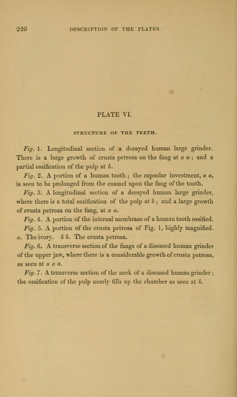 PLATE VI. STRETTURE OF THE TEETH. Fig. 1. Longitudinal section of a decayed human large grinder. There is a large growth of crusta petrosa on the fang at a a ; and a partial ossification of the pulp at b. Fig. 2. A portion of a human tooth ; the capsular investment, a a, is seen to be prolonged from the enamel upon the fang of the tooth. Fig. 3. A longitudinal section of a decayed human large grinder, where there is a total ossification of the pulp at b ; and a large growth of crusta petrosa on the fang, at a a. Fig. 4. A portion of the internal membrane of a human tooth ossified. Fig. 5. A portion of the crusta petrosa of Fig. 1, highly magnified. a. The ivory, b b. The crusta petrosa. Fig. 6. A transverse section of the fangs of a diseased human grinder of the upper jaw, where there is a considerable growth of crusta petrosa, as seen at a a a. Fig. 7. A transverse section of the neck of a diseased human grinder; the ossification of the pulp nearly fills up the chamber as seen at b.