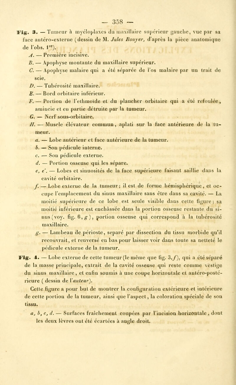 Vis- 3' —Tumeur à myéloplaxcs du liiaxillaire sii|)éricui' fjauclie, vue par sa face antéro-exlerne (dessin de M. Jules Boujer^ d'après la pièce analoraique de l'obs. r«). ^. — Première incisive. B. — Apophyse montante du maxillaire supérieur. C. — Apophyse malaire qui a été séparée de l'os malaire par un trait de scie. £). — Tubérosité maxillaire. E. — Bord orbitaire inférieur. F. — Portion de l'ethmoïde et du plancher orbitaire qui a été refoulée, amincie et eu partie détruite par la tumeur. G. — Nerf sous-orbitaire. II. — Muscle élévateur commun, aplati sur la face antérieure de la tu- meur. a. — Lobe antérieur et face antérieure de la tumeur. b. — Son pédicule interne. c. — Son pédicule externe. d. — Portion osseuse qui les sépare. e. e. — Lobes et sinuosités de la face supérieure faisant saillie dans la cavité orbitaire. f. — Lobe externe de la tumeur; il est de forme hémisphérique, et oc- cupe l'emplacement du sinus maxillaire sans être dans sa cavité. — La moitié supérieure de ce lobe est seule visible dans cette fijjure ; sa moitié inférieure est enchâssée dans la portion osseuse restante du si- nus (voy. fig. 6, g'), portion osseuse qui correspond à la tubérosité maxillaire. g.— Lambeau de périoste, séparé par dissection du tissu morbide qu'il recouvrait, et renversé eu bas pour laisser voir dans toute sa netteté le pédicule externe de la tumeur. Fi^. 4. — Lobe externe de cette tumeur (le même que fig. 3,/'), qui a été séparé de la masse principale, extrait de la cavité osseuse qui reste comme vestige du sinus maxillaire, et enlîn soumis à une coupe horizontale et autéro-posté- rieure ( dessin de Vauteur). Cette figure a pour but de montrer la configuration extérieure et intérieure de celte portion de la tumeur, ainsi que l'aspect, la coloration spéciale de sou tissu. a, b, c, d. — Surfaces fraîchement coupées par l'incision horizontale, dont les deux lèvres ont été écartées à anale droit.