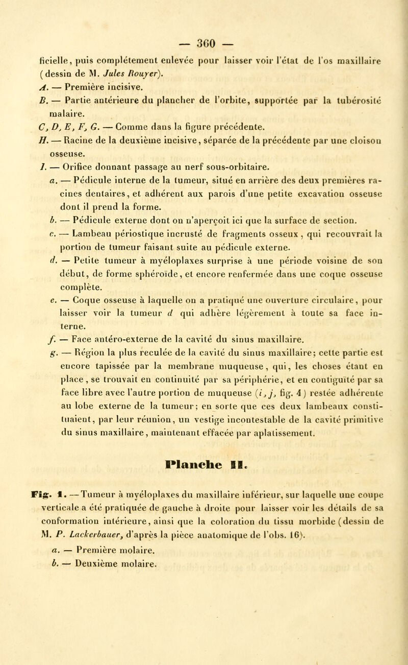 — 300 — licielle, puis complètement eolevée [)Our laisser voir l'étal de l'os maxillaire (dessin de M. Jules Ilouyer). A. — Première incisive, B.— Partie antérieure du plancher de l'orbite, supportée par la lubérosilé malaire. Cj D, E, F, G. — Gomme dans la figure précédente. H. — Racine de la deuxième incisive, séparée de la précédente par une cloison osseuse. /. — Orifice donnant passage au nerf sous-orhitaire. a. — Pédicule interne de la tumeur, situé en arrière des deux premières ra- cines dentaires, et adhérent aux parois d'une petite excavation osseuse dont il prend la forme. b. — Pédicule externe dont on n'aperçoit ici que la surface de section. c. — Lambeau périostique incrusté de fragments osseux , qui recouvrait la portion de tumeur faisant suite au pédicule externe. d. — Petite tumeur à myéloplaxes surprise à une période voisine de son début, de forme sphéroïde, et encore renfermée dans une coque osseuse complète. e. — Coque osseuse à laquelle on a pratiqué une ouverture circulaire, pour laisser voir la tumeur d qui adhère légèrement à toute sa face in- terne. f, — Face antéro-externe de la cavité du sinus maxillaire. g. — Région la plus reculée de la cavité du sinus maxillaire; cette partie est encore tapissée par la membrane muqueuse, qui, les choses étant eu place , se trouvait en continuité par sa périphérie, et en contiguïté par sa face libre avec l'autre portion de muqueuse {i,], fig. 4) restée adhérente au lobe externe de la tumeur; en sorte que ces deux lambeaux consti- tuaient, par leur réunion, un vestige incontestable de la cavité primitive du sinus maxillaire, maintenant effacée par aplatissement. IMaiicbe II. Fig. t. —Tumeur à myéloplaxes du maxillaire inférieur, sur laquelle une coupe verticale a été pratiquée de gauche à droite pour laisser voir les détails de sa conformation intérieure, ainsi que la coloration du tissu morbide (dessin de M. P. Lackerbauer, d'après la pièce auatomique de l'obs. 16). a. — Première molaire. b. — Deuxième molaire.