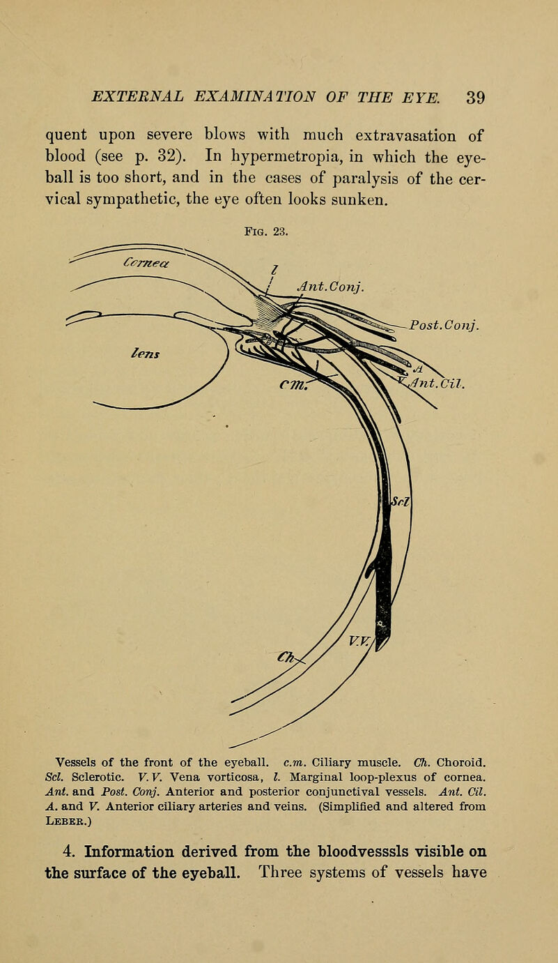 quent upon severe blows with much extravasation of blood (see p. 32). In hypermetropia, in which the eye- ball is too short, and in the cases of paralysis of the cer- vical sympathetic, the eye often looks sunken. Fig. 23. Post.Conj. Oil. Vessels of the front of the eyeball, cot. Ciliary muscle. Ch. Choroid. Scl. Sclerotic. V. V. Vena vorticosa, I. Marginal loop-plexus of cornea. Ant. and Post. Conj. Anterior and posterior conjunctival vessels. Ant. Oil. A. and V. Anterior ciliary arteries and veins. (Simplified and altered from Leber.) 4. Information derived from the bloodvesssls visible on the surface of the eyeball. Three systems of vessels have
