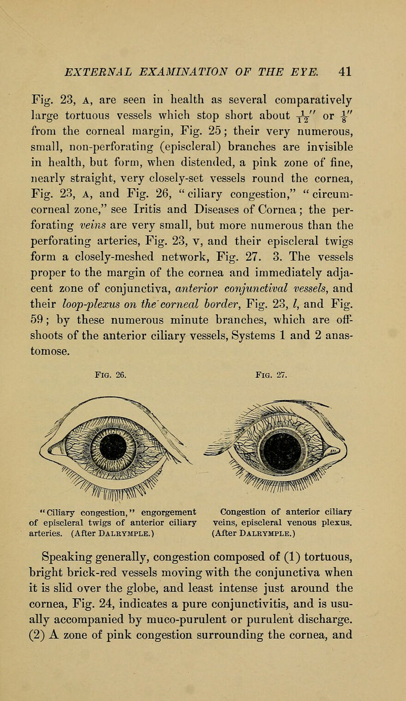 Fig. 23, a, are seen in health as several comparatively large tortuous vessels which stop short about Ty or \ from the corneal margin, Fig. 25; their very numerous, small, non-perforating (episcleral) branches are invisible in health, but form, when distended, a pink zone of fine, nearly straight, very closely-set vessels round the cornea, Fig. 23, a, and Fig. 26,  ciliary congestion,  circum- corneal zone, see Iritis and Diseases of Cornea; the per- forating veins are very small, but more numerous than the perforating arteries, Fig. 23, v, and their episcleral twigs form a closely-meshed network, Fig. 27. 3. The vessels proper to the margin of the cornea and immediately adja- cent zone of conjunctiva, anterior conjunctival vessels, and their loop-plexus on the'corneal border, Fig. 23, I, and Fig. 59; by these numerous minute branches, which are off- shoots of the anterior ciliary vessels, Systems 1 and 2 anas- tomose. Fig. 26. Fig. 27. Ciliary congestion, engorgement of episcleral twigs of anterior ciliary arteries. (After Dalrymple.) Congestion of anterior ciliary veins, episcleral venous plexus. (After Dalrymple.) Speaking generally, congestion composed of (1) tortuous, bright brick-red vessels moving with the conjunctiva when it is slid over the globe, and least intense just around the cornea, Fig. 24, indicates a pure conjunctivitis, and is usu- ally accompanied by muco-purulent or purulent discharge. (2) A zone of pink congestion surrounding the cornea, and