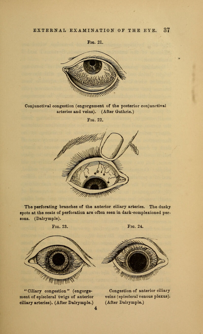 Fig. 21. Conjunctival congestion (engorgement of the posterior conjunctival arteries and veins). (After Guthrie.) Fig. 22. The perforating branches of the anterior ciliary arteries. The dusky spots at the seats of perforation are often seen in dark-complexioned per- sons. (Dalrymple). Fig. 23. Fig. 24. Ciliary congestion (engorge- ment of episcleral twigs of anterior ciliary arteries). (After Dalrymple.) Congestion of anterior ciliary veins (episcleral venous plexus). (After Dalrymple.)