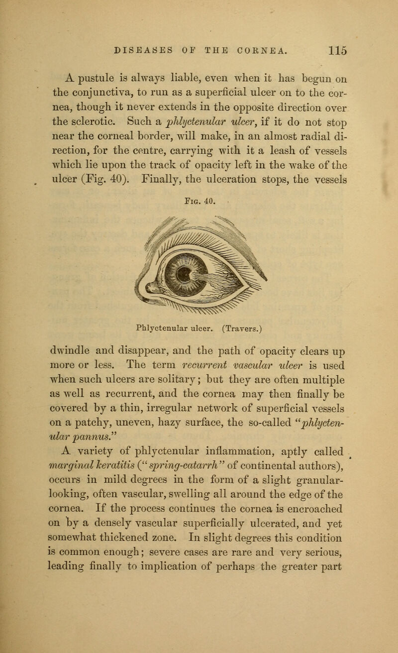 A pustule is always liable, even when it has begun on the conjunctiva, to run as a superficial ulcer on to the cor- nea, though it never extends in the opposite direction over the sclerotic. Such a phlyctenular ulcer, if it do not stop near the corneal border, will make, in an almost radial di- rection, for the centre, carrying with it a leash of vessels which lie upon the track of opacity left in the wake of the ulcer (Fig. 40). Finally, the ulceration stops, the vessels Fig. 40. Phlyctenular ulcer. (Travers.) dwindle and disappear, and the path of opacity clears up more or less. The term recurrent vascular ulcer is used when such ulcers are solitary; but they are often multiple as well as recurrent, and the cornea may then finally be covered by a thin, irregular network of superficial vessels on a patchy, uneven, hazy surface, the so-called phlycten- ular pannus. A variety of phlyctenular inflammation, aptly called marginal keratitis (spring-catarrh of continental authors), occurs in mild degrees in the form of a slight granular- looking, often vascular, swelling all around the edge of the cornea. If the process continues the cornea is encroached on by a densely vascular superficially ulcerated, and yet somewhat thickened zone. In slight degrees this condition is common enough; severe cases are rare and very serious, leading finally to implication of perhaps the greater part