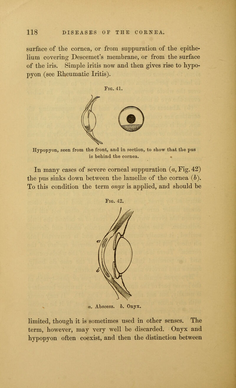 surface of the cornea, or from suppuration of the epithe- lium covering Descemet's membrane, or from the surface of the iris. Simple iritis now and then gives rise to hypo- pyon (see Rheumatic Iritis). Fig. 41. Hypopyon, seen from the front, and in section, to show that the pus is behind the cornea. In many cases of severe corneal suppuration (a, Fig. 42) the pus sinks down between the lamellae of the cornea (b). To this condition the term onyx is applied, and should be Fig. 42. a. Abscess. 6. Onyx. limited, though it is sometimes used in other senses. The term, however, may very well be discarded. Onyx and hypopyon often coexist, and then the distinction between