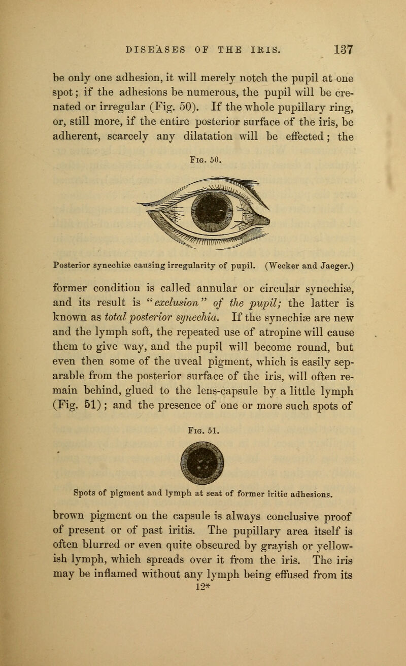 be only one adhesion, it will merely notch the pupil at one spot; if the adhesions be numerous, the pupil will be cre- nated or irregular (Fig. 50). If the whole pupillary ring, or, still more, if the entire posterior surface of the iris, be adherent, scarcely any dilatation will be effected; the Fig. 50. Posterior synechias causing irregularity of pupil. (Wecker and Jaeger.) former condition is called annular or circular synechia?, and its result is exclusion of the pupil; the latter is known as total posterior synechia. If the synechia? are new and the lymph soft, the repeated use of atropine will cause them to give way, and the pupil will become round, but even then some of the uveal pigment, which is easily sep- arable from the posterior surface of the iris, will often re- main behind, glued to the lens-capsule by a little lymph (Fig. 51) ; and the presence of one or more such spots of Fig. 51. Spots of pigment and lymph at seat of former iritic adhesions. brown pigment on the capsule is always cod elusive proof of present or of past iritis. The pupillary area itself is often blurred or even quite obscured by grayish or yellow- ish lymph, which spreads over it from the iris. The iris may be inflamed without any lymph being effused from its 12*