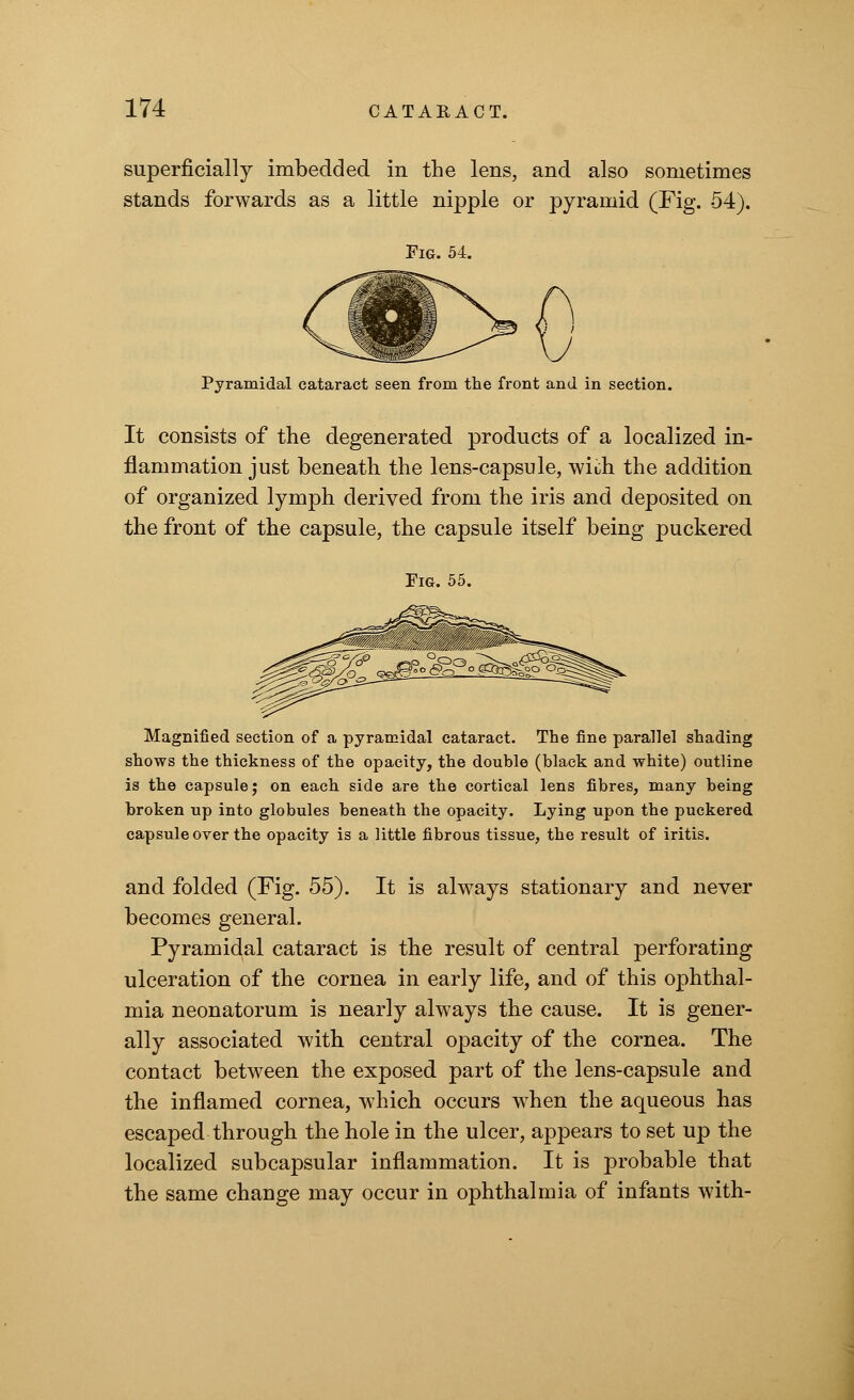 superficially imbedded in the lens, and also sometimes stands forwards as a little nipple or pyramid (Fig. 54). Fig. 54. Pyramidal cataract seen from the front and in section. It consists of the degenerated products of a localized in- flammation just beneath the lens-capsule, with the addition of organized lymph derived from the iris and deposited on the front of the capsule, the capsule itself being puckered Fig. 55. Magnified section of a pyramidal cataract. The fine parallel shading shows the thickness of the opacity, the double (black and white) outline is the capsule j on each side are the cortical lens fibres, many being broken up into globules beneath the opacity. Lying upon the puckered capsule over the opacity is a little fibrous tissue, the result of iritis. and folded (Fig. 55). It is always stationary and never becomes general. Pyramidal cataract is the result of central perforating ulceration of the cornea in early life, and of this ophthal- mia neonatorum is nearly always the cause. It is gener- ally associated with central opacity of the cornea. The contact between the exposed part of the lens-capsule and the inflamed cornea, which occurs when the aqueous has escaped through the hole in the ulcer, appears to set up the localized subcapsular inflammation. It is probable that the same change may occur in ophthalmia of infants with-