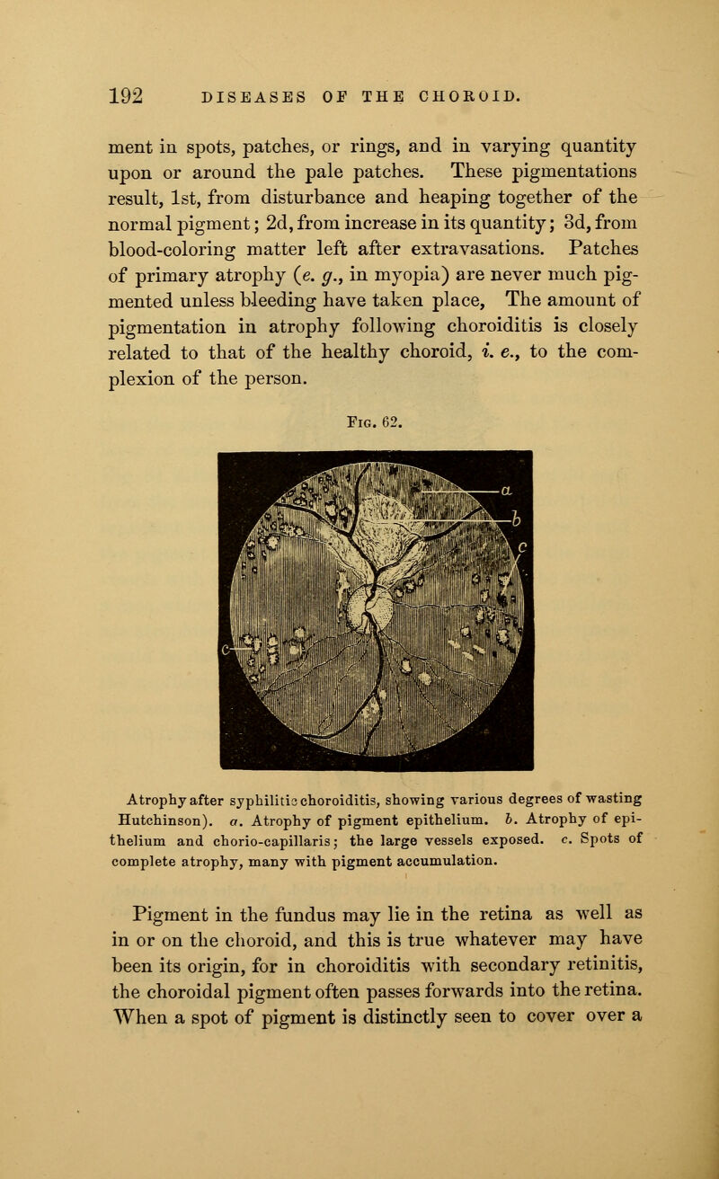 merit in spots, patches, or rings, and in varying quantity upon or around the pale patches. These pigmentations result, 1st, from disturbance and heaping together of the normal pigment; 2d, from increase in its quantity; 3d, from blood-coloring matter left after extravasations. Patches of primary atrophy (e. g.f in myopia) are never much pig- mented unless bleeding have taken place, The amount of pigmentation in atrophy following choroiditis is closely related to that of the healthy choroid, i. e., to the com- plexion of the person. Fig. 62. Atrophy after syphilids choroiditis, showing various degrees of wasting Hutchinson), a. Atrophy of pigment epithelium, b. Atrophy of epi- thelium and chorio-capillaris; the large vessels exposed, c. Spots of complete atrophy, many with pigment accumulation. Pigment in the fundus may lie in the retina as well as in or on the choroid, and this is true whatever may have been its origin, for in choroiditis with secondary retinitis, the choroidal pigment often passes forwards into the retina. When a spot of pigment is distinctly seen to cover over a