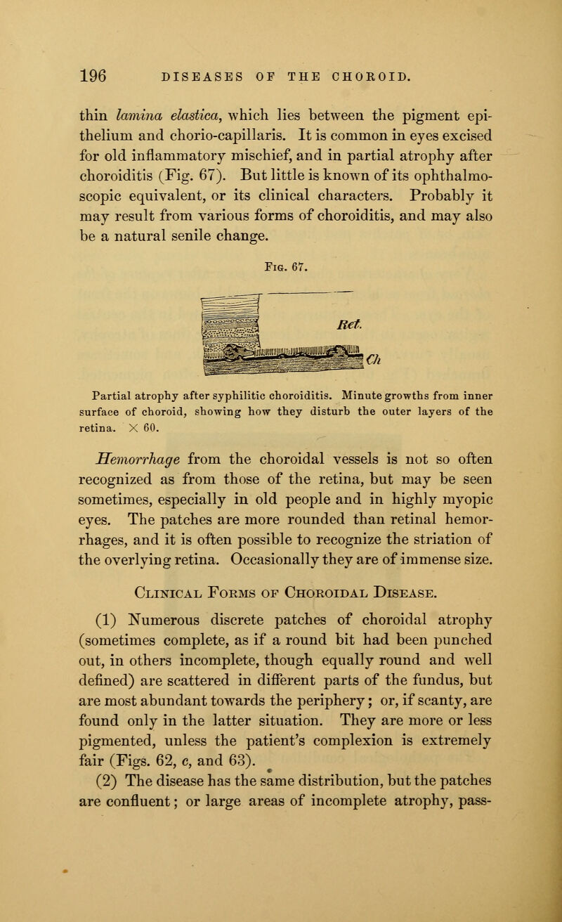 thin lamina elastiea, which lies between the pigment epi- thelium and chorio-capillaris. It is common in eyes excised for old inflammatory mischief, and in partial atrophy after choroiditis (Fig. 67). But little is known of its ophthalmo- scopic equivalent, or its clinical characters. Probably it may result from various forms of choroiditis, and may also be a natural senile change. Fig. 67. Partial atrophy after syphilitic choroiditis. Minute growths from inner surface of choroid, showing how they disturb the outer layers of the retina. X 60. Hemorrhage from the choroidal vessels is not so often recognized as from those of the retina, but may be seen sometimes, especially in old people and in highly myopic eyes. The patches are more rounded than retinal hemor- rhages, and it is often possible to recognize the striation of the overlying retina. Occasionally they are of im mense size. Clinical Forms of Choroidal Disease. (1) Numerous discrete patches of choroidal atrophy (sometimes complete, as if a round bit had been punched out, in others incomplete, though equally round and well defined) are scattered in different parts of the fundus, but are most abundant towards the periphery; or, if scanty, are found only in the latter situation. They are more or less pigmented, unless the patient's complexion is extremely fair (Figs. 62, c, and 63). (2) The disease has the same distribution, but the patches are confluent; or large areas of incomplete atrophy, pass-