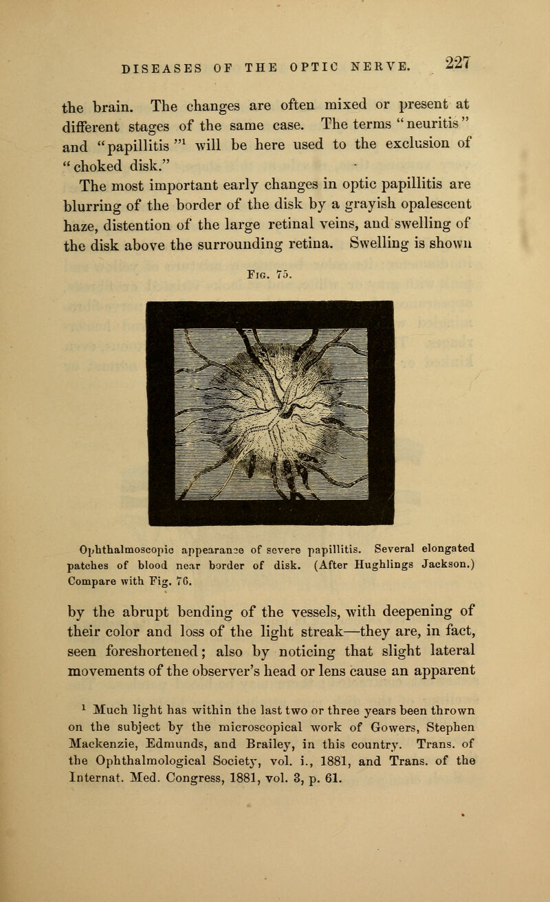 the brain. The changes are often mixed or present at different stages of the same case. The terms  neuritis  and papillitis1 will be here used to the exclusion of choked disk. The most important early changes in optic papillitis are blurring of the border of the disk by a grayish opalescent haze, distention of the large retinal veins, and swelling of the disk above the surrounding retina. Swelling is shown Fig. 75. Ophthalmoscopic appearance of severe papillitis. Several elongated patches of hlood near border of disk. (After Hughlings Jackson.) Compare with Fig. 76. by the abrupt bending of the vessels, with deepening of their color and loss of the light streak—they are, in fact, seen foreshortened; also by noticing that slight lateral movements of the observer's head or lens cause an apparent 1 Much light has within the last two or three years been thrown on the subject by the microscopical work of Gowers, Stephen Mackenzie, Edmunds, and Brailey, in this country. Trans, of the Ophthalmological Society, vol. i., 1881, and Trans, of the Internat. Med. Congress, 1881, vol. 3, p. 61.