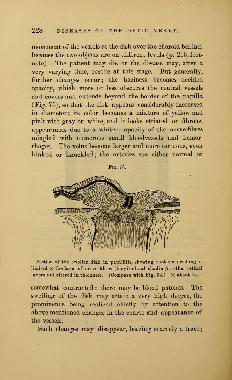 movement of the vessels at the disk over the choroid behind, because the two objects are on different levels (p. 213, foot- note). The patient may die or the disease may, after a very varying time, recede at this stage. But generally, further changes occur; the haziness becomes decided opacity, which more or less obscures the central vessels and covers and extends beyond the border of the papilla (Fig. 75), so that the disk appears considerably increased in diameter; its color becomes a mixture of yellow and pink with gray or white, and it looks striated or fibrous, appearances due to a whitish opacity of the nerve-fibres mingled with numerous small bloodvessels and hemor- rhages. The veins become larger and more tortuous, even kinked or knuckled; the arteries are either normal or Fig. 76. Section of the swollen disk in papillitis, showing that the swelling is limited to the layer of nerve-fibres (longitudinal shading); other retinal layers not altered in thickness. (Compare with Fig. 34.) X about 15. somewhat contracted ; there may be blood patches. The swelling of the disk may attain a very high degree, the prominence being realized chiefly by attention to the above-mentioned changes in the course and appearance of the vessels. Such changes may disappear, leaving scarcely a trace;