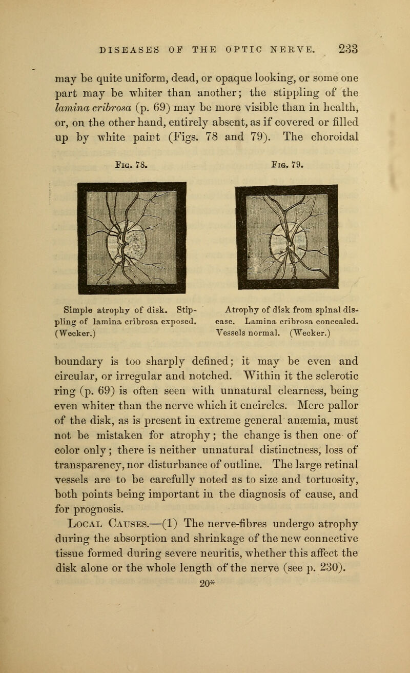 may be quite uniform, dead, or opaque looking, or some one part may be whiter than another; the stippling of the lamina cribrosa (p. 69) may be more visible than in health, or, on the other hand, entirely absent, as if covered or filled up by white pairt (Figs. 78 and 79). The choroidal Fig. 78. Fig. 79. Simple atrophy of disk. Stip- Atrophy of disk from spinal dis- pling of lamina cribrosa exposed. ease. Lamina cribrosa concealed. (Wecker.) Vessels normal. (Wecker.) boundary is too sharply defined; it may be even and circular, or irregular and notched. Within it the sclerotic ring (p. 69) is often seen with unnatural clearness, being even whiter than the nerve which it encircles. Mere pallor of the disk, as is present in extreme general anaemia, must not be mistaken for atrophy; the change is then one of color only; there is neither unnatural distinctness, loss of transparency, nor disturbance of outline. The large retinal vessels are to be carefully noted as to size and tortuosity, both points being important in the diagnosis of cause, and for prognosis. Local Causes.—(1) The nerve-fibres undergo atrophy during the absorption and shrinkage of the new connective tissue formed during severe neuritis, whether this affect the disk alone or the whole length of the nerve (see p. 230). 20*