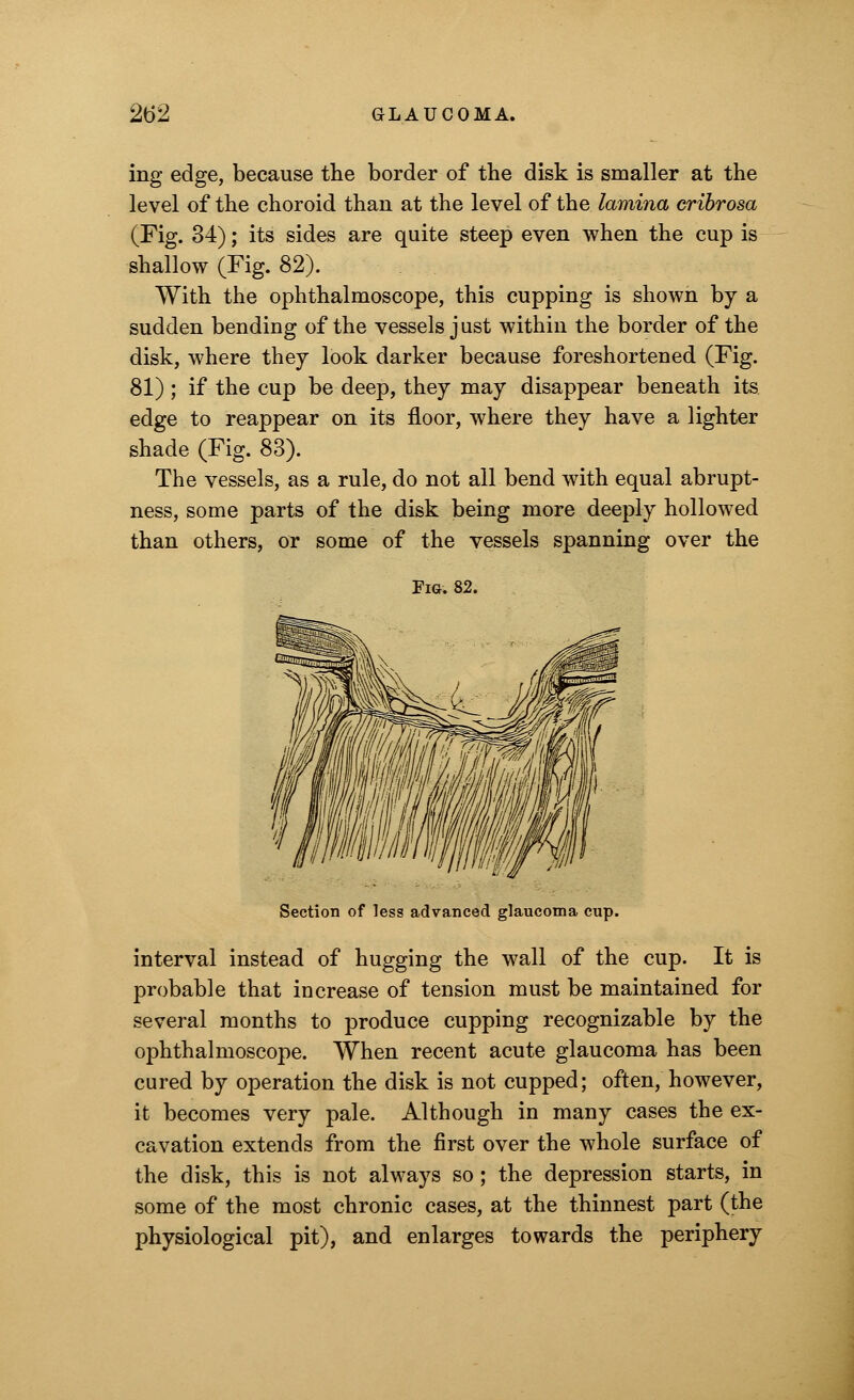 ing edge, because the border of the disk is smaller at the level of the choroid than at the level of the lamina cribrosa (Fig. 34); its sides are quite steep even when the cup is shallow (Fig. 82). With the ophthalmoscope, this cupping is shown by a sudden bending of the vessels just within the border of the disk, where they look darker because foreshortened (Fig. 81) ; if the cup be deep, they may disappear beneath its. edge to reappear on its floor, where they have a lighter shade (Fig. 83). The vessels, as a rule, do not all bend with equal abrupt- ness, some parts of the disk being more deeply hollowed than others, or some of the vessels spanning over the Fig. 82. Section of less advanced glaucoma cup. interval instead of hugging the wall of the cup. It is probable that increase of tension must be maintained for several months to produce cupping recognizable by the ophthalmoscope. When recent acute glaucoma has been cured by operation the disk is not cupped; often, however, it becomes very pale. Although in many cases the ex- cavation extends from the first over the whole surface of the disk, this is not always so; the depression starts, in some of the most chronic cases, at the thinnest part (the physiological pit), and enlarges towards the periphery