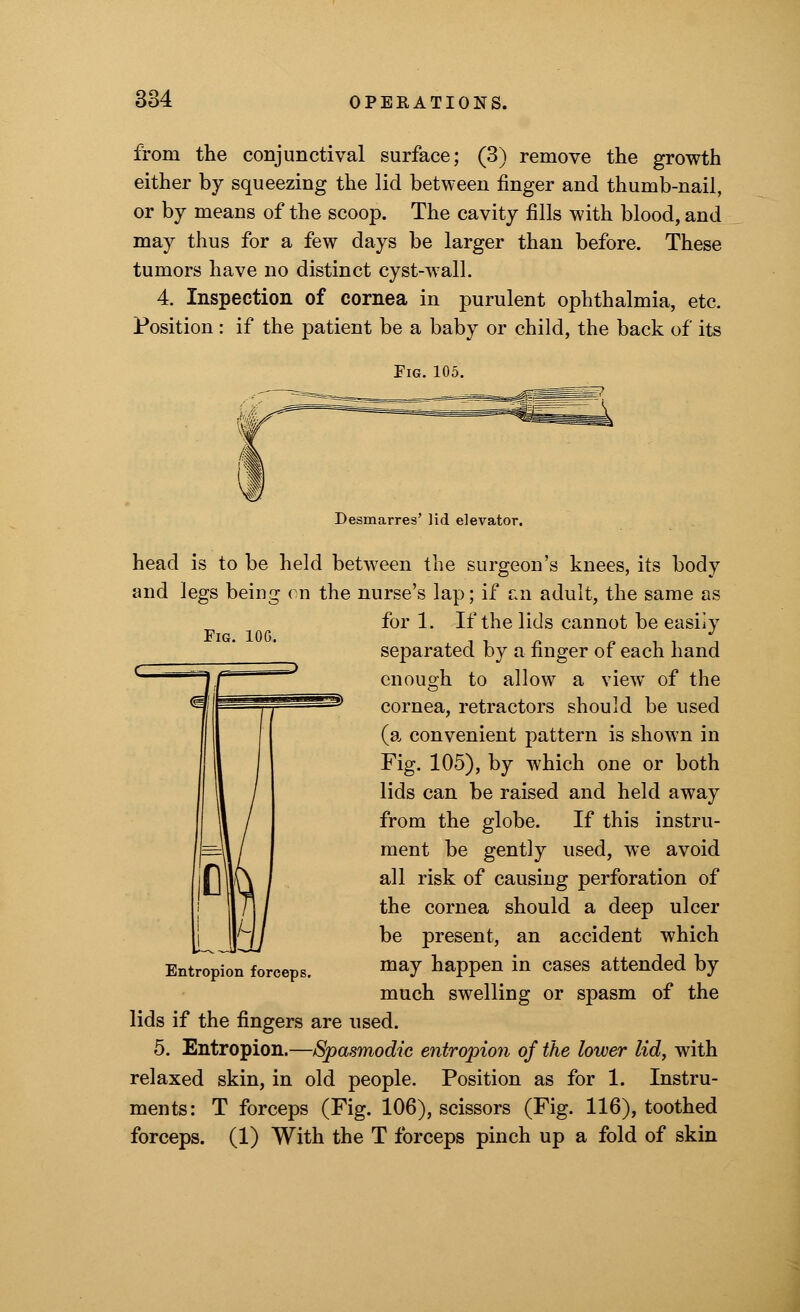 from the conjunctival surface; (3) remove the growth either by squeezing the lid between finger and thumb-nail, or by means of the scoop. The cavity fills with blood, and may thus for a few days be larger than before. These tumors have no distinct cyst-wall. 4. Inspection of cornea in purulent ophthalmia, etc. Position : if the patient be a baby or child, the back of its Fig. 105. Fig. 100. Desmarres' lid elevator. head is to be held between the surgeon's knees, its body and legs being on the nurse's lap; if en adult, the same as for 1. If the lids cannot be easily separated by a finger of each hand enough to allow a view of the cornea, retractors should be used (a convenient pattern is shown in Fig. 105), by which one or both lids can be raised and held away from the globe. If this instru- ment be gently used, we avoid all risk of causing perforation of the cornea should a deep ulcer be present, an accident which may happen in cases attended by much swelling or spasm of the lids if the fingers are used. 5. Entropion.—Spasmodic entropion of the lower lid, with relaxed skin, in old people. Position as for 1. Instru- ments: T forceps (Fig. 106), scissors (Fig. 116), toothed forceps. (1) With the T forceps pinch up a fold of skin Entropion forceps.