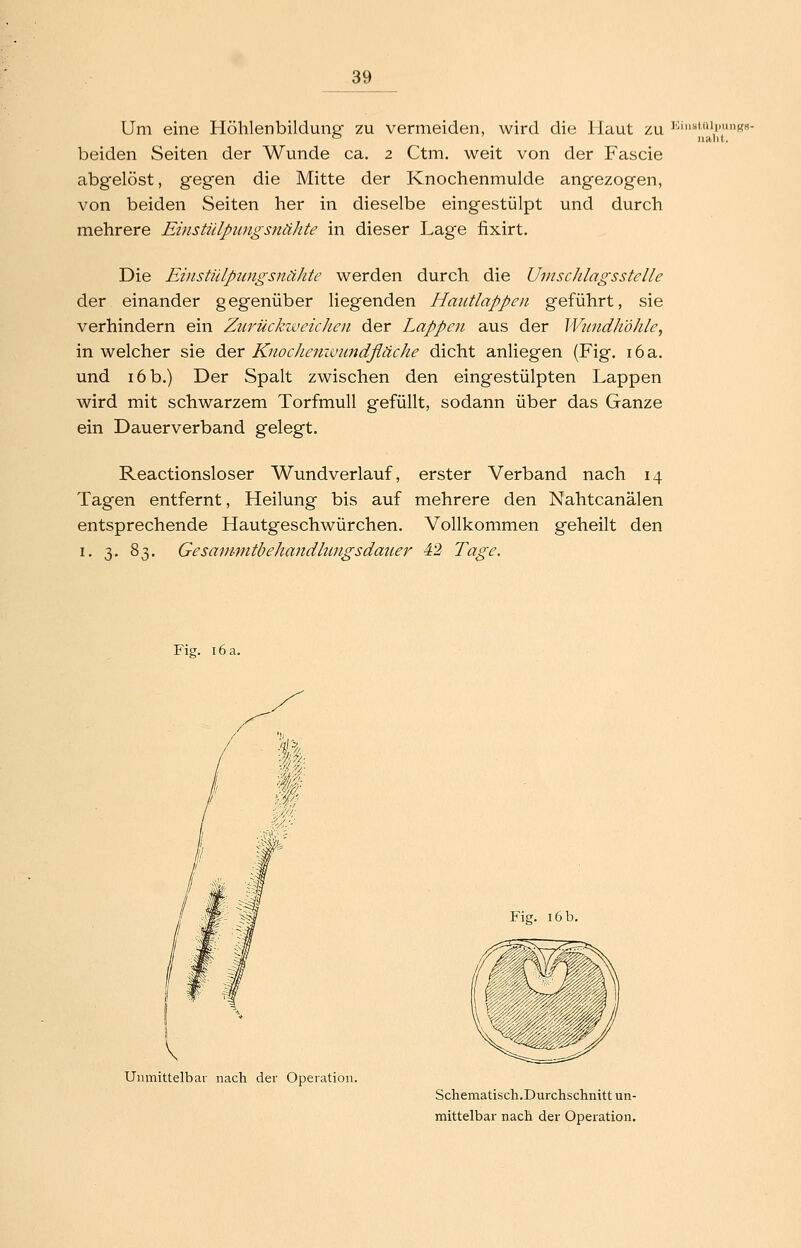 wird die Haut zu i'^'«tii'gs- ualit. Um eine Höhlenbildung zu vermeiden beiden Seiten der Wunde ca. 2 Ctm. weit von der Fascie abgelöst, gegen die Mitte der Knochenmulde angezogen, von beiden Seiten her in dieselbe eingestülpt und durch mehrere Emstülpu7igsnähte in dieser Lage fixirt. Die Eiiistülpwigsnähte werden durch die UmscJUagsstelle der einander gegenüber liegenden Hautlappen geführt, sie verhindern ein Zurückweichen der Lappen aus der Wn?idhdhle, in welcher sie der Knochemvundfläche dicht anliegen (Fig. i6a. und i6b.) Der Spalt zwischen den eingestülpten Lappen wird mit schwarzem Torfmull gefüllt, sodann über das Ganze ein Dauerverband gelegt. Reactionsloser Wundverlauf, erster Verband nach 14 Tagen entfernt, Heilung bis auf mehrere den Nahtcanälen entsprechende Hautgeschwürchen. Vollkommen geheilt den I. 3. 83. Gesanimtbehandlungsdauer 42 Tage. Fig. i6a. Fig. i6b. Unmittelbar nach der Operation. Schenaatisch.Durchschnitt un- mittelbar nach der Operation.