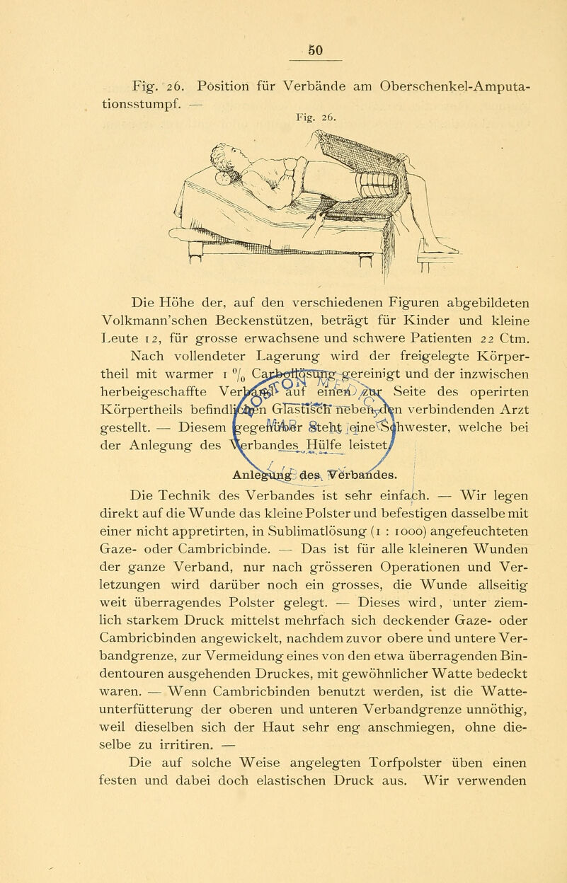 Fig. 2 6. Position für Verbände am Oberschenkel-Amputa- tionsstumpf. — Fig. 26. Die Höhe der, auf den verschiedenen Figuren abgebildeten Volkmann'schen Beckenstützen, beträgt für Kinder und kleine Leute 12, für grosse erwachsene und schwere Patienten 22 Ctm. Nach vollendeter Lagerung wird der freigelegte Körper- theil mit warmer i /^ CapfecriföSl^rg-g.ereinigt und der inzwischen herbeigeschaffte Verljf^L^^ auf em^fO/ztir Seite des operirten Körpertheils befindlyc^n GTäsH^Ti neben^oten verbindenden Arzt gestellt. — Diesem tegenIviDSr Steh^^eine^Ähwester, welche bei der Anlegung des ^rbandes^Hülfe^ leistet/ Die Technik des Verbandes ist sehr einfach. — Wir legen direkt auf die Wunde das kleine Polster und befestigen dasselbe mit einer nicht appretirten, in Sublimatlösung (i : 1000) angefeuchteten Gaze- oder Cambricbinde. — Das ist für alle kleineren Wunden der ganze Verband, nur nach grösseren Operationen und Ver- letzungen wird darüber noch ein grosses, die Wunde allseitig weit überragendes Polster gelegt. — Dieses wird, unter ziem- lich starkem Druck mittelst mehrfach sich deckender Gaze- oder Cambricbinden angewickelt, nachdem zuvor obere und untere Ver- bandgrenze, zur Vermeidung eines von den etwa überragenden Bin- dentouren ausgehenden Druckes, mit gewöhnlicher Watte bedeckt waren. — Wenn Cambricbinden benutzt werden, ist die Watte- unterfütterung der oberen und unteren Verbandgrenze unnöthig, weil dieselben sich der Haut sehr eng anschmiegen, ohne die- selbe zu irritiren. — Die auf solche Weise angelegten Torfpolster üben einen festen und dabei doch elastischen Druck aus. Wir verwenden