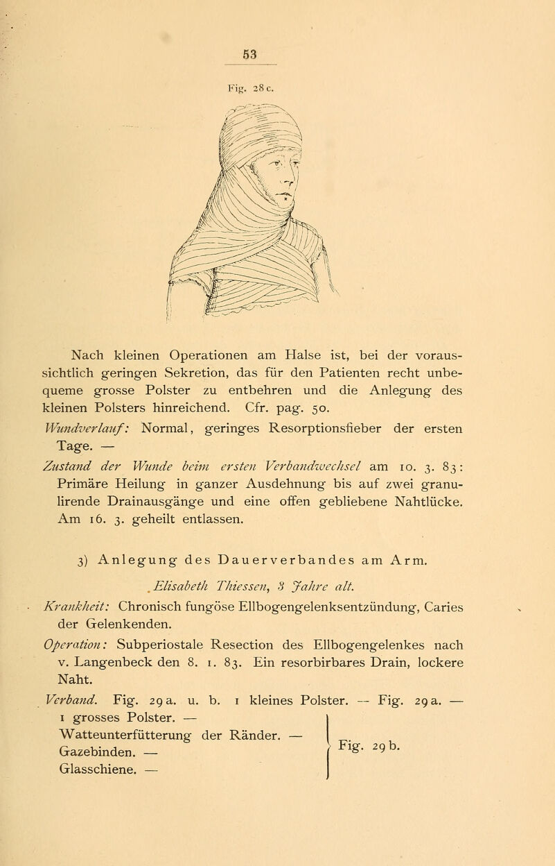 Nach kleinen Operationen am Halse ist, bei der voraus- sichtlich geringen Sekretion, das für den Patienten recht unbe- queme grosse Polster zu entbehren und die Anleg'ung des kleinen Polsters hinreichend. Cfr. pag. 50. Wundverlauf: Normal, geringes Resorptionsfieber der ersten Tage. — Zustand der Wunde beim ersten Verbandzvechsel am 10. 3, 83: Primäre Heilung in ganzer Ausdehnung bis auf zwei granu- lirende Drainausgänge und eine offen gebliebene Nahtlücke. Am 16. 3. geheilt entlassen. 3) Anlegung des Dauerverbandes am Arm. ^ Elisabeth Thiessen, 3 Jahre alt. Krankheit: Chronisch fungöse Ellbogengelenksentzündung, Caries der Gelenkenden. Operation: Subperiostale Resection des Ellbogengelenkes nach V. Langenbeck den 8. i. 83. Ein resorbirbares Drain, lockere Naht. Verband. Fig. 29 a. u. b. i kleines Polster. — Fig. 29 a. — I grosses Polster. — j Watteunterfütterung der Ränder. — Gazebinden. - ) ^''^' '^b- Glasschiene. —