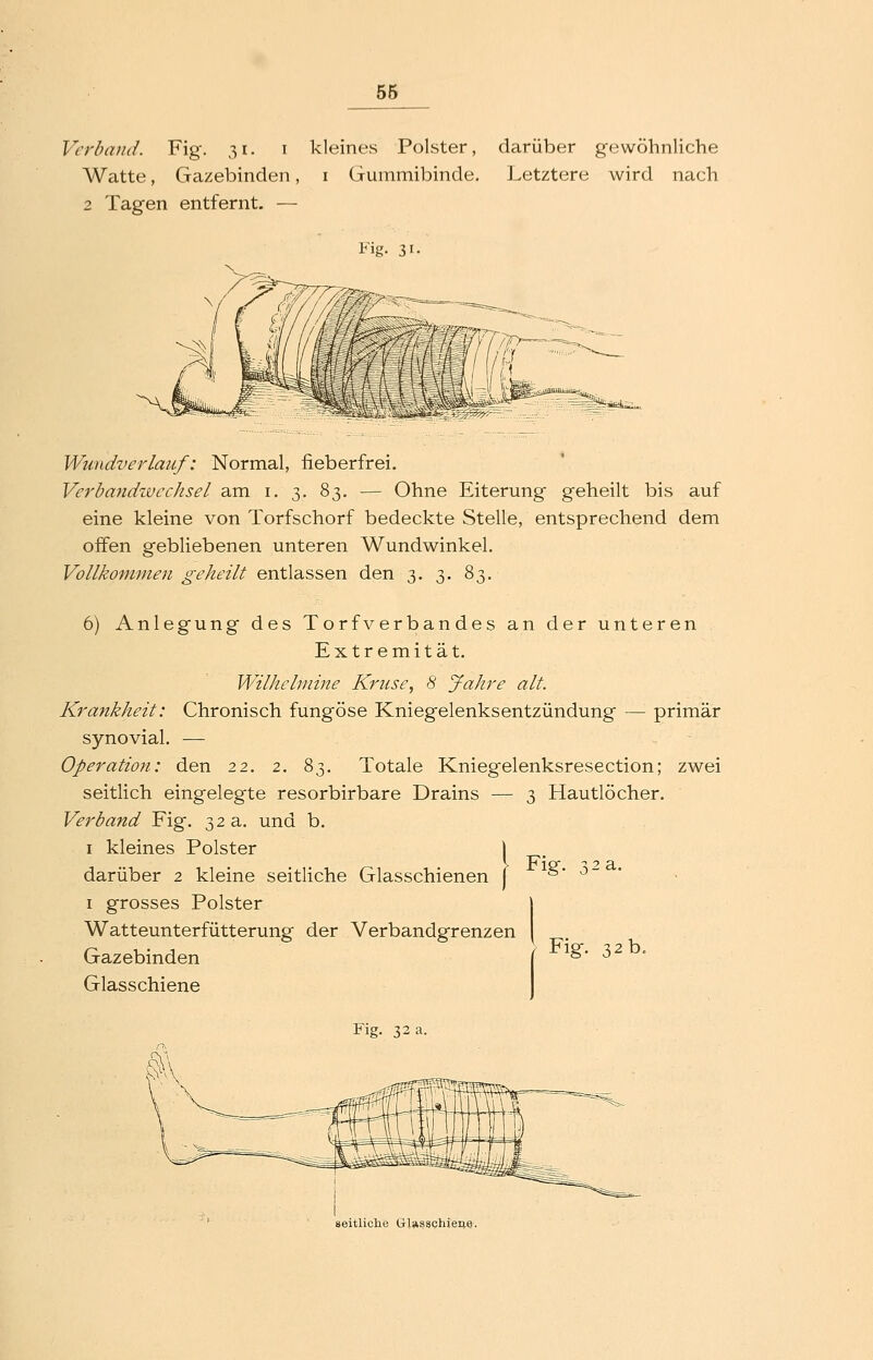 Verband. Fig. 31. i kleines Polster, darüber gewöhnliche Watte, Gazebinden, i Gummibinde. Letztere wird nach 2 Tagen entfernt. — Wundverlauf: Normal, fieberfrei. Verbandivcchsel am i. 3. 83. — Ohne Eiterung geheilt bis auf eine kleine von Torfschorf bedeckte Stelle, entsprechend dem offen gebliebenen unteren Wundwinkel, Vollkommen geheilt entlassen den 3. 3. 83. 6) Anlegung des Torf Verbandes an der unteren Extremität. Wilhebnine Kruse, 8 Jahre alt. Krankheit: Chronisch fungöse Kniegelenksentzündung — primär synovial. — Operation: den 22. 2. 83. Totale Kniegelenksresection; zwei seitlich eingelegte resorbirbare Drains — 3 Hautlöcher. Verband Fig. 32 a. und b. I kleines Polster darüber 2 kleine seitliche Glasschienen f I grosses Polster Watteunterfütterung der Verbandgrenzen Gazebinden Glasschiene Fig. 32 a. Fig. ,2 a. Fig. 32 b. seitliclie Glasschiene.