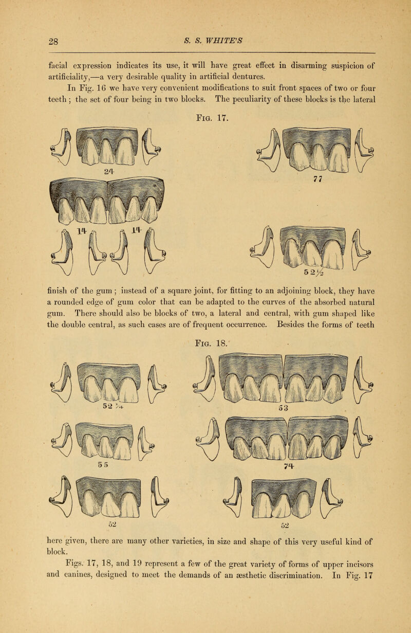 facial expression indicates its use, it will have great effect in disarming suspicion of artificiality,—a very desirable quality in artificial dentures. In Fig. 16 we have very convenient modifications to suit front spaces of two or four teeth ; the set of four being in two blocks. The peculiarity of these blocks is the lateral Fig. 17. finish of the gum ; instead of a square joint, for fitting to an adjoining block, they have a rounded edge of gum color that can be adapted to the curves of the absorbed natural gum. There should also be blocks of two, a lateral and central, with gum shaped like the double central, as such cases are of frequent occurrence. Besides the forms of teeth Fig. 18. 52 > here given, there are many other varieties, in size and shape of this very useful kind of block. Figs. 17, 18, and 19 represent a few of the great variety of forms of upper incisors and canines, designed to meet the demands of an aesthetic discrimination. In Fig. 17