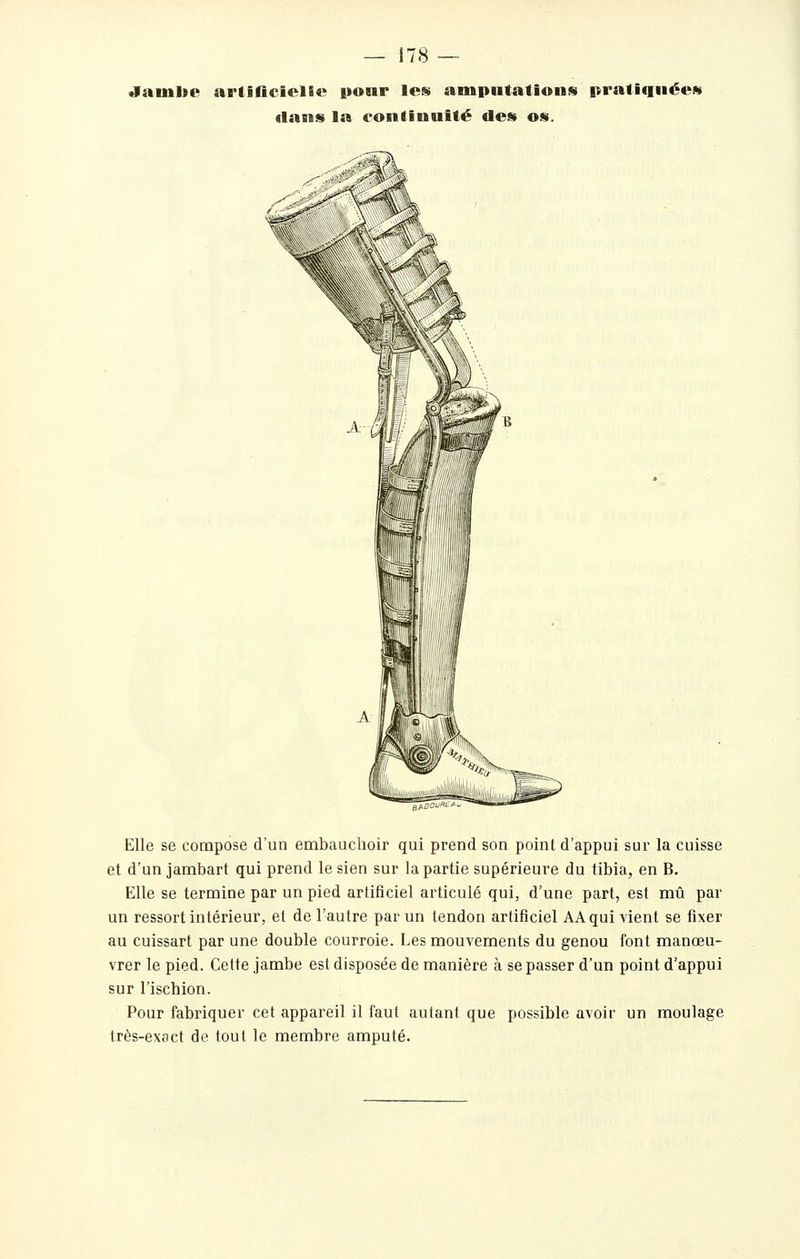 •fauilie arliflciclEe pour les ampntatioiifi |trali<iiiées dans la continuité des os. Elle se compose d'un embauchoir qui prend son point d'appui sur la cuisse et d'un jambart qui prend le sien sur la partie supérieure du tibia, en B. Elle se termine par un pied artificiel articulé qui, d'une part, est mû par un ressort intérieur, et de l'autre par un tendon artificiel AAqui vient se fixer au cuissart par une double courroie. Les mouvements du genou font manœu- vrer le pied. Cette jambe est disposée de manière à se passer d'un point d'appui sur l'ischion. Pour fabriquer cet appareil il faut autant que possible avoir un moulage très-exoct de tout le membre amputé.