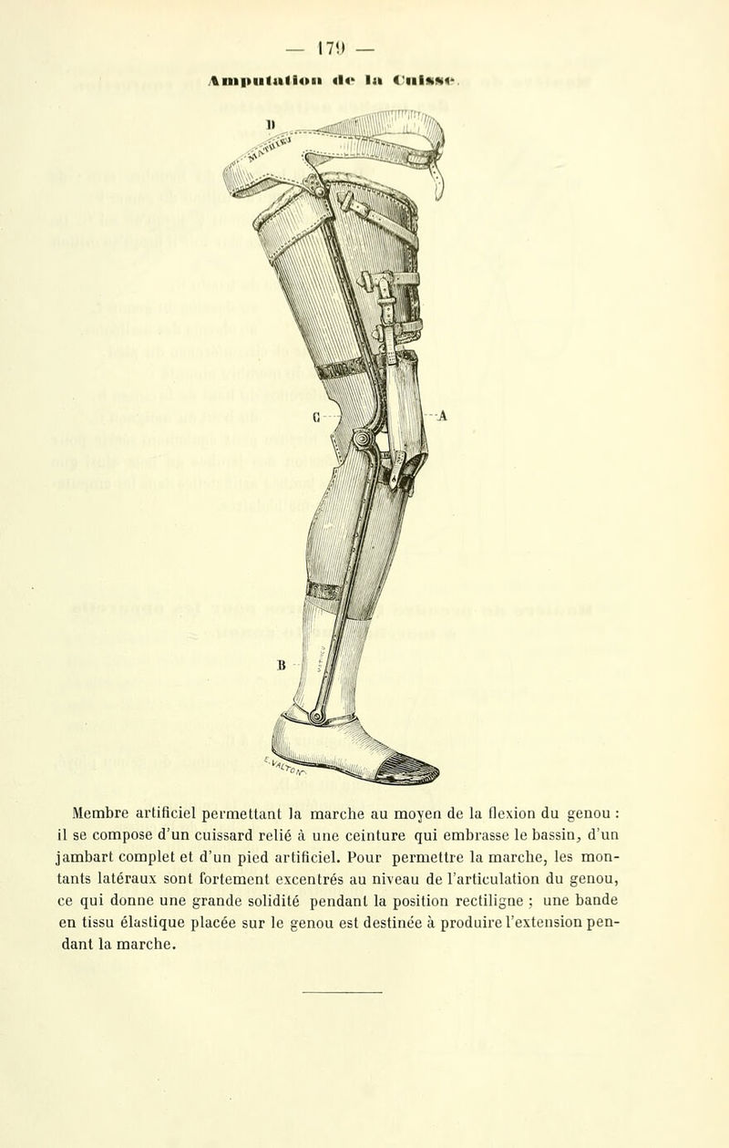 — I7«l — ;%ni|»lllali4»ll 4l4' la t'illKM^' Membre artificiel permettant la marche au moyen de la flexion du genou : il se compose d'un cuissard relié à une ceinture qui embrasse le bassin, d'un jambart complet et d'un pied artificiel. Pour permettre la marche, les mon- tants latéraux sont fortement excentrés au niveau de l'articulation du genou, ce qui donne une grande solidité pendant la position rectiligne ; une bande en tissu élastique placée sur le genou est destinée à produire l'extension pen- dant la marche.