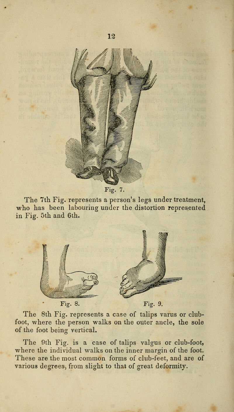 The 7tli Fig. represents a person's legs under treatment, who has been labouring under the distortion represented in Fig. 5th and 6th. Fig. 8. Fig. 9. The 8th Fig. represents a case of talips varus or club- foot, where the person walks on the outer ancle, the sole of the foot being vertical. The 9th Fig. is a case of talips valgus or club-foot, where the individual walks on the inner margin of the foot. These are the most common forms of club-feet, and are of various degrees, from slight to that of great deformity.