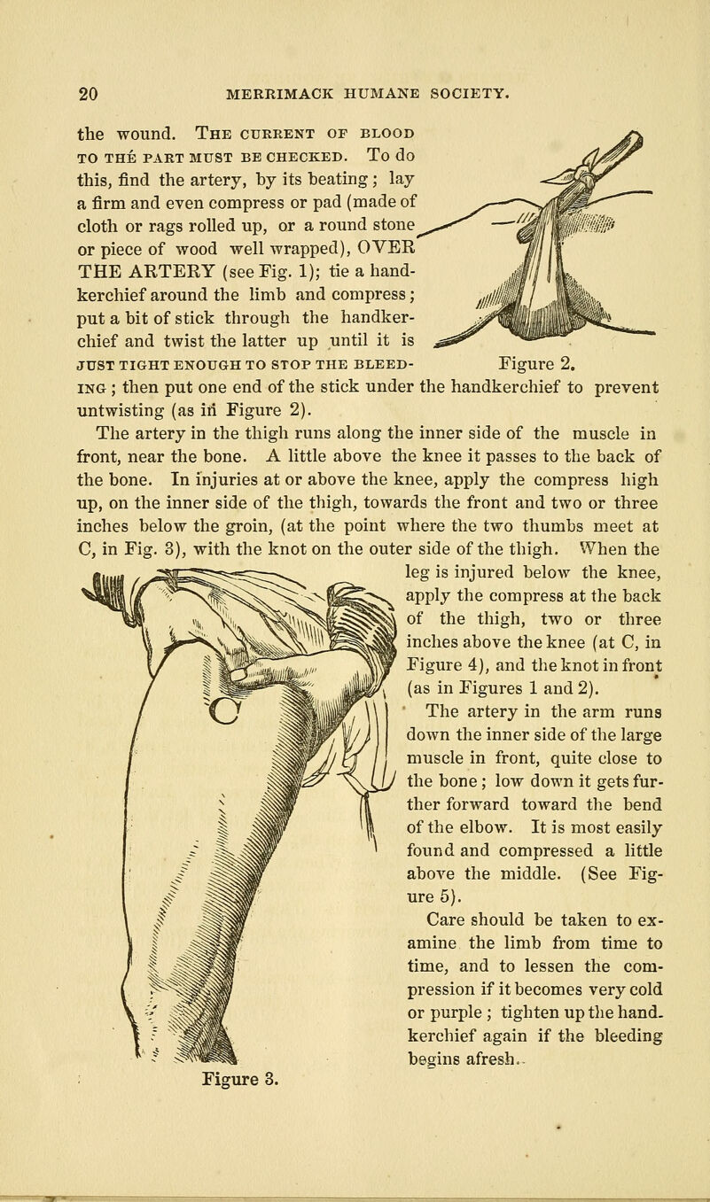 Figure 2. the wound. The current of blood TO THE PART MUST BE CHECKED. To do this, find the artery, by its heating; lay a firm and even compress or pad (made of cloth or rags rolled up, or a round stone^ or piece of wood well wrapped), OVER THE ARTERY (seeEig. 1); tie a hand- kerchief around the limb and compress; put a bit of stick through the handker- chief and twist the latter up until it is JUST TIGHT ENOUGH TO STOP THE BLEED- ING ; then put one end of the stick under the handkerchief to prevent untwisting (as iri Figure 2). The artery in the thigh runs along the inner side of the muscle in front, near the bone. A little above the knee it passes to the back of the bone. In injuries at or above the knee, apply the compress high up, on the inner side of the thigh, towards the front and two or three inches below the groin, (at the point where the two thumbs meet at C, in Fig. 3), with the knot on the outer side of the thigh. When the leg is injured below the knee, apply the compress at the back of the thigh, two or three inches above the knee (at C, in Figure 4), and the knot in front (as in Figures 1 and 2). The artery in the arm runs down the inner side of the large muscle in front, quite close to the bone ; low down it gets fur- ther forward toward the bend of the elbow. It is most easily found and compressed a little above the middle. (See Fig- ure 5). Care should be taken to ex- amine the limb from time to time, and to lessen the com- pression if it becomes very cold or purple ; tighten up tlie hand, kerchief again if the bleeding begins afresh.. Figure 3.