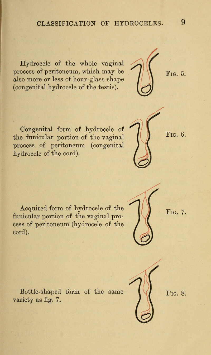 Hydrocele of the whole vaginal process of peritoneum, which may be also more or less of hour-glass shape (congenital hydrocele of the testis). Fig. 5. Congenital form of hydrocele of the funicular portion of the vaginal process of peritoneum (congenital hydrocele of the cord). Fig. 6. Acquired form of hydrocele of the funicular portion of the vaginal pro- cess of peritoneum (hydrocele of the cord). Fig. 7. Bottle-shaped form of the same Fig.