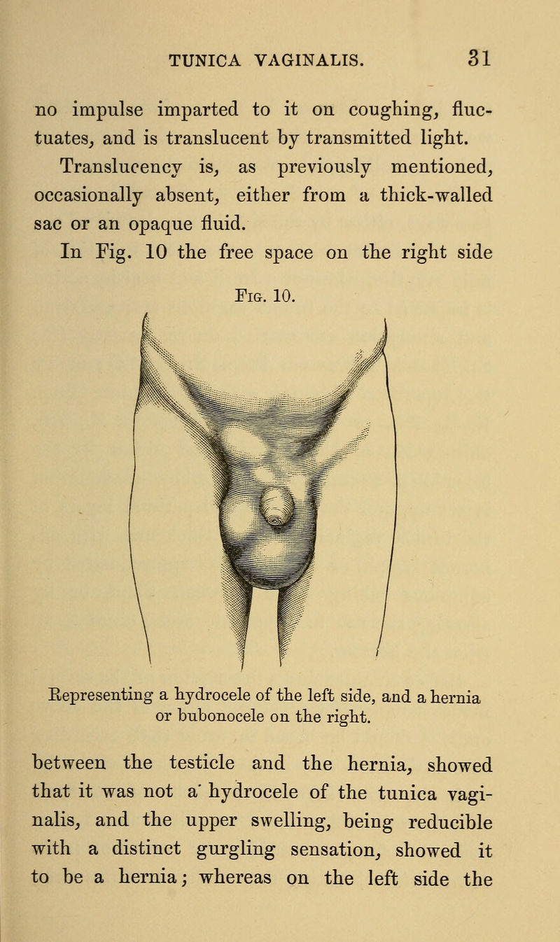 no impulse imparted to it on coughing, fluc- tuates, and is translucent by transmitted light. Translucency is, as previously mentioned, occasionally absent, either from a thick-walled sac or an opaque fluid. In Fig. 10 the free space on the right side Fig. 10. Bepresenting a hydrocele of the left side, and a hernia or bubonocele on the right. between the testicle and the hernia, showed that it was not a' hydrocele of the tunica vagi- nalis, and the upper swelling, being reducible with a distinct gurgling sensation, showed it to be a hernia; whereas on the left side the