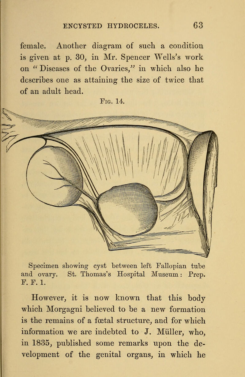 female. Another diagram of such a condition is given at p. 30, in Mr. Spencer Wells's work on  Diseases of the Ovaries/'' in which also he describes one as attaining the size of twice that of an adult head. Fig. 14 Specimen showing cyst between left Fallopian tube and ovary. St. Thomas's Hospital Museum: Prep. F.F.I. However, it is now known that this body which Morgagni believed to be a new formation is the remains of a foetal structure, and for which information we are indebted to J. Muller, who, in 1835, published some remarks upon the de- velopment of the genital organs, in which he