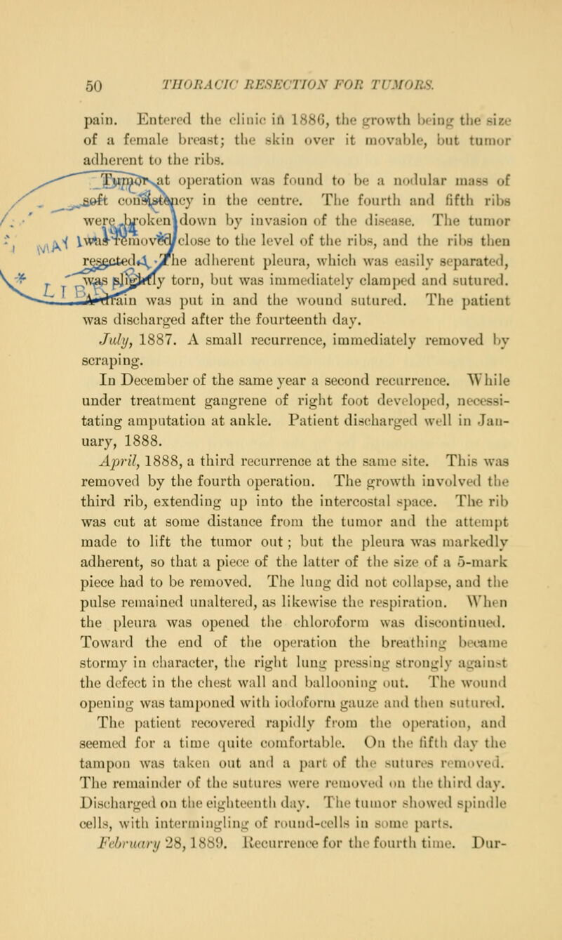 pain. Ent(MTfl the olini(! irt 188G, tlie t^rowth lK'in<; the nize of a female breast; the skin over it rnoviihle, l)iit tumor adherent to the ribs. ^t operation was found to be a nodular mass of ney in the eentre. The fourth and fifth ribs wereJifokenidown by invasion of the disease. The tumor .\^ l.\^'til-TCmoviP^close to the level of the ribs, and the ribs then r^^cted4^yf he adherent pleura, which was easily separated, torn, but was immediately clamped and sutured. Fain was put in and the wound sutured. The patient was discharged after the fourteenth day. July, 1887. A small recurrence, immediately removed by scraping. In December of the same year a second recurrence. While under treatment gangrene of right foot developed, necessi- tating amputation at ankle. Patient discharged well in Jan- uary, 1888. April, 1888, a third recurrence at the same site. This was removed by the fourth operation. The growth involved the third rib, extending up into the intercostal space. The rib was cut at some distance from the tumor and the attempt made to lift the tumor out; but the pleura was markedly adherent, so that a piece of the latter of the size of a 5-mark piece had to be removed. Tiie lung did not collapse, and the pulse remained unaltered, as likewise the respiration. When the pleura was opened the chloroform was discontinueil. Toward the end of the operation the breathing became stormy in character, the right liuig pressing strongly atraiu^t the defect in the chest wall and ballooning out. The wound opening was tamponed with iodoform gauze and then suturt-^l. The patient recovered rapidly from the operation, and seemed for a time quite coinfortablo. On the fifth day the tampon was taken out and a part of the sutures removed. The remainder of the sutures were removeil on the third day. Dischargetl on the eighteenth day. The tumor showed spindle cells, with intermingling of round-cells in some parts. February 28,1889. Recurrence for tlii> fourth time. Dur-