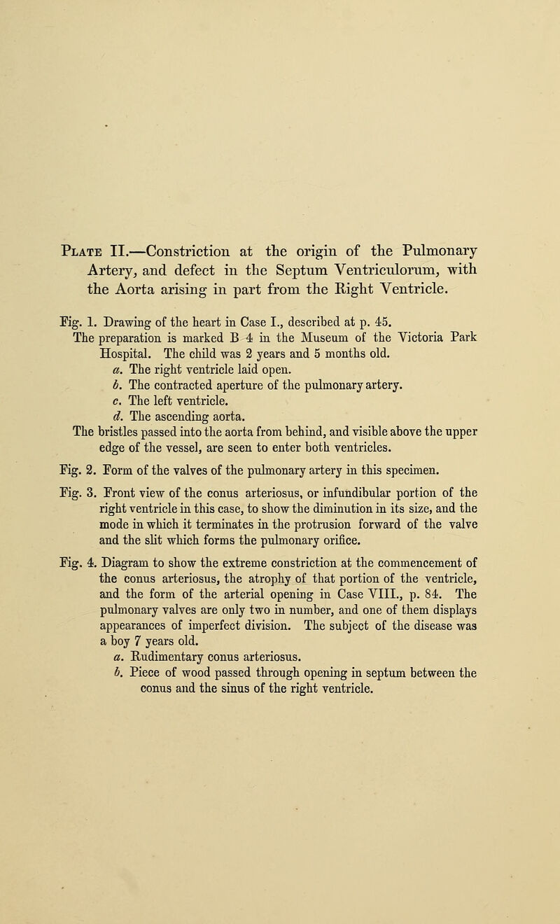 Plate II.—Constriction at the origin of tlie Pulmonary Artery,, and defect in the Septum Ventriculorum^ with the Aorta arising in part from the Right Ventricle. Kg. 1. Drawing of the heart in Case I., described at p. 45, The preparation is marked B 4 in the Museum of the Victoria Park Hospital. The chUd was 2 years and 5 months old. a. The right ventricle laid open. b. The contracted aperture of the pulmonary artery. c. The left ventricle. d. The ascending aorta. The bristles passed into the aorta from behind, and visible above the upper edge of the vessel, are seen to enter both ventricles. Fig. 2. Form of the valves of the pulmonary artery in this specimen. Fig. 3. Front view of the conus arteriosus, or infundibular portion of the right ventricle in this case, to show the diminution in its size, and the mode in which it terminates in the protrusion forward of the valve and the slit which forms the pulmonary orifice. Fig. 4. Diagram to show the extreme constriction at the commencement of the conus arteriosus, the atrophy of that portion of the ventricle, and the form of the arterial opening in Case VIII., p. 84. The pulmonary valves are only two in number, and one of them displays appearances of imperfect division. The subject of the disease was a boy 7 years old. a. Rudimentary conus arteriosus. h. Piece of wood passed through opening in septum between the conus and the sinus of the right ventricle.