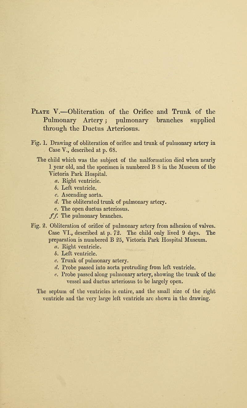 Plate V.—Obliteration of the Orifice and Trunk of tlie Pulmonary Artery; pulmonary branches supplied through the Ductus Arteriosus. Fig. 1. Drawiug of obliteration of orifice and trunk of pulmonary artery in Case v., described at p. 68. The child which was the subject of the malformation died when nearly 1 year old, and the specimen is numbered B 8 in the Museum of the Victoria Park Hospital. a. Right ventricle. b. Left ventricle. c. Ascending aorta. d. The obliterated trunk of pulmonary artery. e. The open ductus arteriosus. ff. The pulmonary branches. Fig. 2. Obliteration of orifice of pulmonary artery from adhesion of valves. Case VI., described at p. 72. The child only lived 9 days. The preparation is numbered B 25, Victoria Park Hospital Museum. a. Right ventricle. b. Left ventricle. c. Trunk of pulmonary artery. d. Probe passed into aorta protruding from left ventricle. e. Probe passed along pulmonary artery, showing the trunk of the vessel and ductus arteriosus to be largely open. The septum of the ventricles is entire, and the small size of the right ventricle and the very large left ventricle are shown in the drawing.