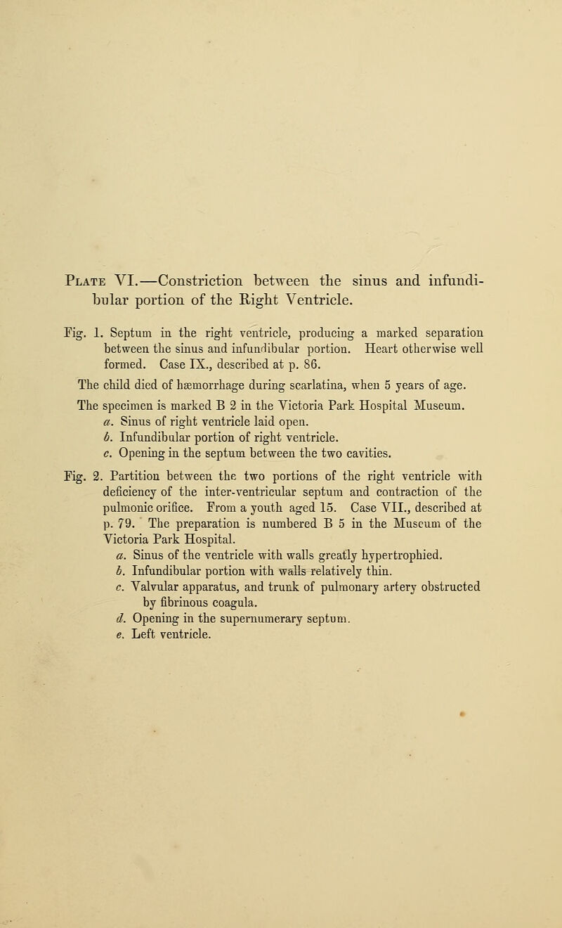 Plate VI,—Constriction bet^veen the sinus and infundi- bular portion of the Rigbt Ventricle. Kg. 1. Septum in the right ventricle, producing a marked separation between the sinus and infundibular portion. Heart otherwise well formed. Case IX., described at p. 86. The child died of hsemorrhage during scarlatina, when 5 years of age. The specimen is marked B 2 in the Victoria Park Hospital Museum. a. Sinus of right ventricle laid open. b. Infundibular portion of right ventricle. c. Opening in the septum between the two cavities. Fig. 2. Partition between the two portions of the right ventricle with deficiency of the inter-ventricular septum and contraction of the pulmonic orifice. From a youth aged 15. Case VII., described at p. 79. The preparation is numbered B 5 in the Museum of the Victoria Park Hospital. a. Sinus of the ventricle with walls greatly hypertrophied. b. Infundibular portion with walls relatively thin. c. Valvular apparatus, and trunk of pulmonary artery obstructed by fibrinous coagula. d. Opening in the supernumerary septum. e. Left ventricle.
