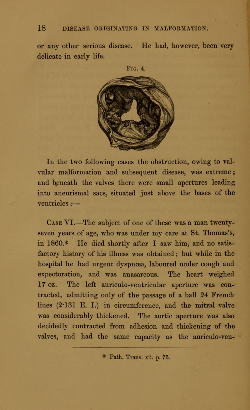 or any other serious disease. He had, however, been very delicate in early life. Fig. 4. In the two following cases the obstruction, owing to val- vular malformation and subsequent disease, was extreme; and beneath the valves there were small apertures leading into aneurismal sacs, situated just above the bases of the ventricles:— Case VI.—The subject of one of these was a man twenty- seven years of age, who was under my care at St. Thomas's, in I860.* He died shortly after I saw him, and no satis- factory history of his illness was obtained; but while in the hospital he had urgent dyspnoea, laboured under cough and expectoration, and was anasarcous. The heart weighed 17 oz. The left auriculo-ventricular aperture was con- tracted, admitting only of the passage of a ball 24 French lines (2*131 E. I.) in circumference, and the mitral valve was considerably thickened. The aortic aperture was also decidedly contracted from adhesion and thickening of the valves, and had the same capacity as the auriculo-ven-