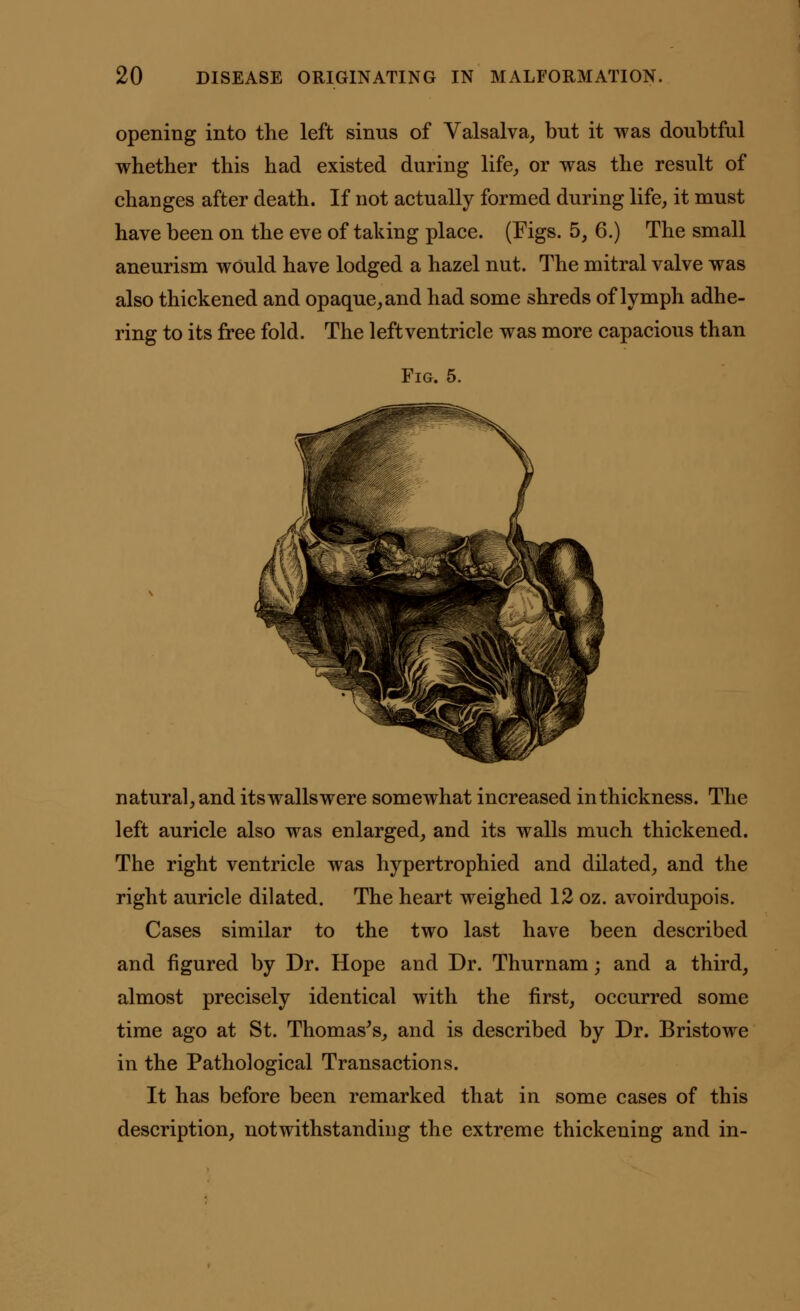 opening into the left sinus of Valsalva, but it was doubtful whether this had existed during life, or was the result of changes after death. If not actually formed during life, it must have been on the eve of taking place. (Figs. 5, 6.) The small aneurism would have lodged a hazel nut. The mitral valve was also thickened and opaque, and had some shreds of lymph adhe- ring to its free fold. The leftventricle was more capacious than Fig. 5. natural, and itswallswere somewhat increased in thickness. The left auricle also was enlarged, and its walls much thickened. The right ventricle was hypertrophied and dilated, and the right auricle dilated. The heart weighed 12 oz. avoirdupois. Cases similar to the two last have been described and figured by Dr. Hope and Dr. Thurnam; and a third, almost precisely identical with the first, occurred some time ago at St. Thomas's, and is described by Dr. Bristowe in the Pathological Transactions. It has before been remarked that in some cases of this description, notwithstanding the extreme thickening and in-