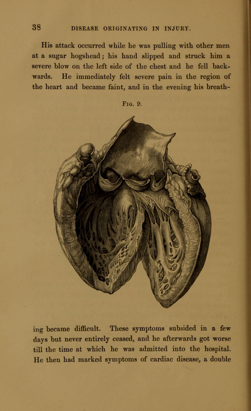 His attack occurred while he was pulling with other men at a sugar hogshead; his hand slipped and struck him a severe blow on the left side of the chest and he fell hack- wards. He immediately felt severe pain in the region of the heart and became faint, and in the evening his breath- Fig. 9. ing became difficult. These symptoms subsided in a few days but never entirely ceased, and he afterwards got worse till the time at which he was admitted into the hospital. He then had marked symptoms of cardiac disease, a double