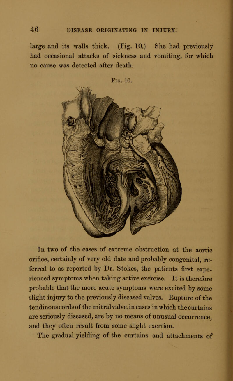 large and its walls thick. (Fig. 10.) She had previously had occasional attacks of sickness and vomiting, for which no cause was detected after death. Fig. 10. In two of the cases of extreme obstruction at the aortic orifice, certainly of very old date and probably congenital, re- ferred to as reported by Dr. Stokes, the patients first expe- rienced symptoms when taking active exercise. It is therefore probable that the more acute symptoms were excited by some slight injury to the previously diseased valves. Rupture of the tendinous cords of the mitral valve, in cases in which the curtains are seriously diseased, are by no means of unusual occurrence, and they often result from some slight exertion. The gradual yielding of the curtains and attachments of