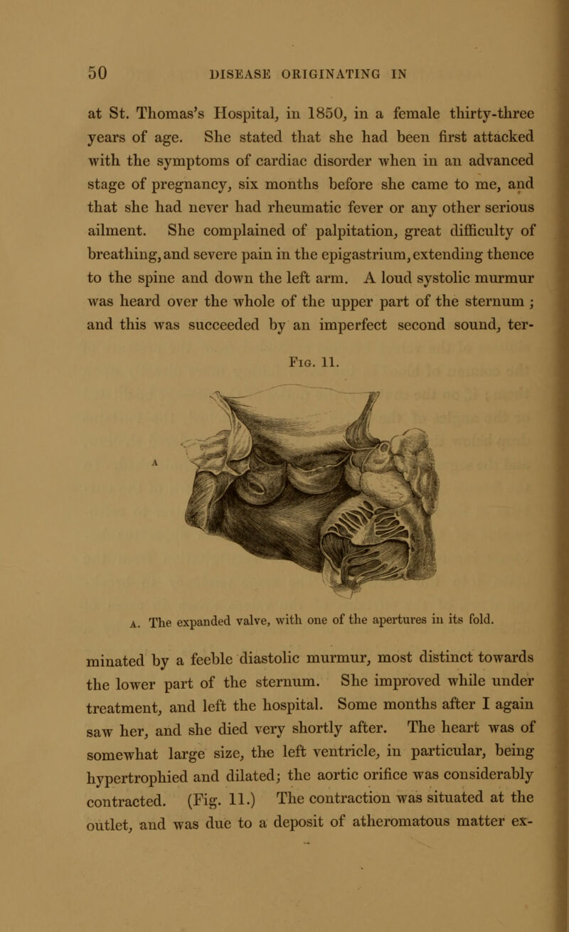 at St. Thomas's Hospital, in 1850, in a female thirty-three years of age. She stated that she had been first attacked with the symptoms of cardiac disorder when in an advanced stage of pregnancy, six months before she came to me, and that she had never had rheumatic fever or any other serious ailment. She complained of palpitation, great difficulty of breathing, and severe pain in the epigastrium, extending thence to the spine and down the left arm. A loud systolic murmur was heard over the whole of the upper part of the sternum ; and this was succeeded by an imperfect second sound, ter- Fig. 11. a. The expanded valve, with one of the apertures in its fold. minated by a feeble diastolic murmur, most distinct towards the lower part of the sternum. She improved while under treatment, and left the hospital. Some months after I again saw her, and she died very shortly after. The heart was of somewhat large size, the left ventricle, in particular, being hypertrophied and dilated; the aortic orifice was considerably contracted. (Fig. 11.) The contraction was situated at the outlet, and was due to a deposit of atheromatous matter ex-