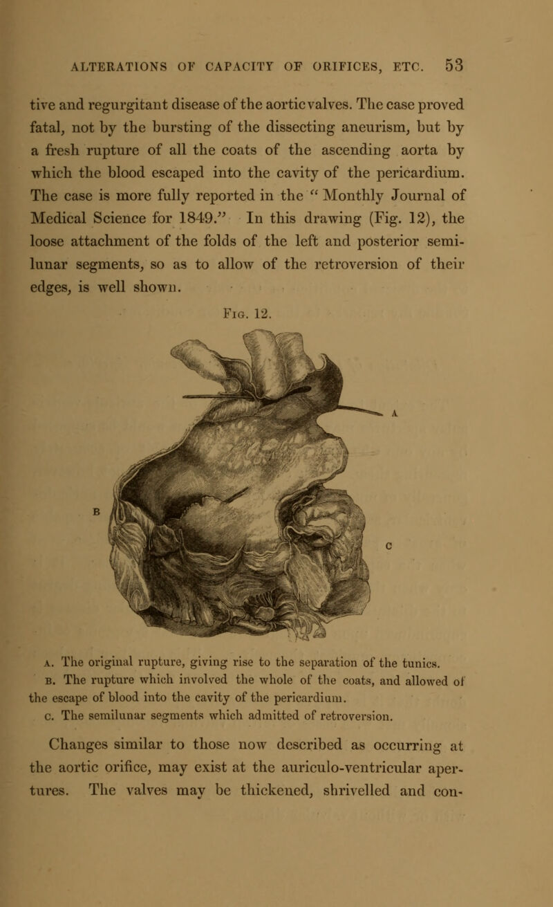 tive and regurgitant disease of the aortic valves. The case proved fatal, not by the bursting of the dissecting aneurism, but by a fresh rupture of all the coats of the ascending aorta by which the blood escaped into the cavity of the pericardium. The case is more fully reported in the' Monthly Journal of Medical Science for 1849. In this drawing (Fig. 12), the loose attachment of the folds of the left and posterior semi- lunar segments, so as to allow of the retroversion of their edges, is well shown. Fig. 12. a. The original rupture, giving rise to the separation of the tunics. b. The rupture which involved the whole of the coats, and allowed of the escape of blood into the cavity of the pericardium. c. The semilunar segments which admitted of retroversion. Changes similar to those now described as occurring at the aortic orifice, may exist at the auriculo-ventricular aper- tures. The valves may be thickened, shrivelled and con-