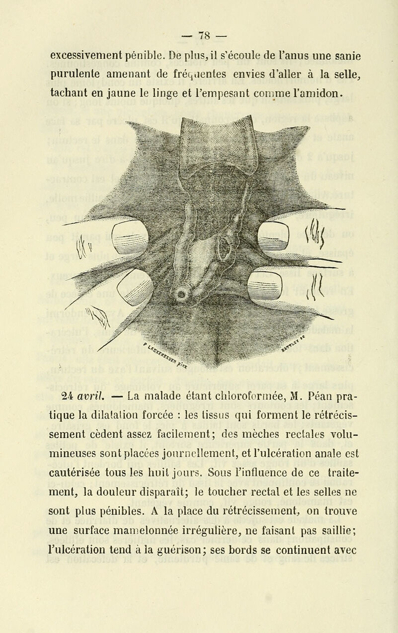 excessivement pénible. De plus, il s'écoule de l'anus une sanie purulente amenant de fréquentes envies d'aller à la selle, tachant en jaune le linge et l'empesant comme l'amidon. 'r'-v-v  ^ 24 avril. — La malade étant chloroformée, M. Péan pra- tique la dilatation forcée : les tissus qui forment le rétrécis- sement cèdent assez facilement; des mèches rectales volu- mineuses sont placées journellement, et l'ulcération anale est cautérisée tous les huit jours. Sous l'influence de ce traite- ment, la douleur disparaît; le toucher rectal et les selles ne sont plus pénibles. A la place du rétrécissement, on trouve une surface mamelonnée irrégulière, ne faisant pas saillie; l'ulcération tend à la guérison; ses bords se continuent avec