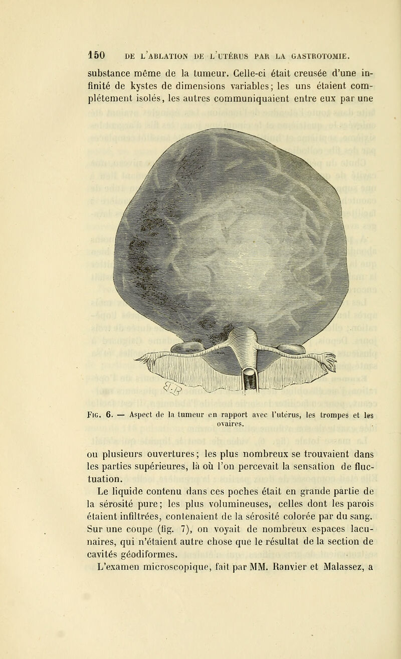 substance même de la tumeur. Celle-ci était creusée d'une in- finité de kystes de dimensions variables; les uns étaient com- plètement isolés, les autres communiquaient entre eux par une Fig. 6. — Aspect de la tumeur en rapport avec l'utérus, les trompes et les ovaires. ou plusieurs ouvertures; les plus nombreux se trouvaient dans les parties supérieures, là où l'on percevait la sensation de fluc- tuation. Le liquide contenu dans ces poches était en grande partie de la sérosité pure ; les plus volumineuses, celles dont les parois étaient infiltrées, contenaient de la sérosité colorée par du sang. Sur une coupe (fig. 7), on voyait de nombreux espaces lacu- naires, qui n'étaient autre chose que le résultat de la section de cavités géodiformes. L'examen microscopique, fait par MM. Ranv.ier et Malassez, a