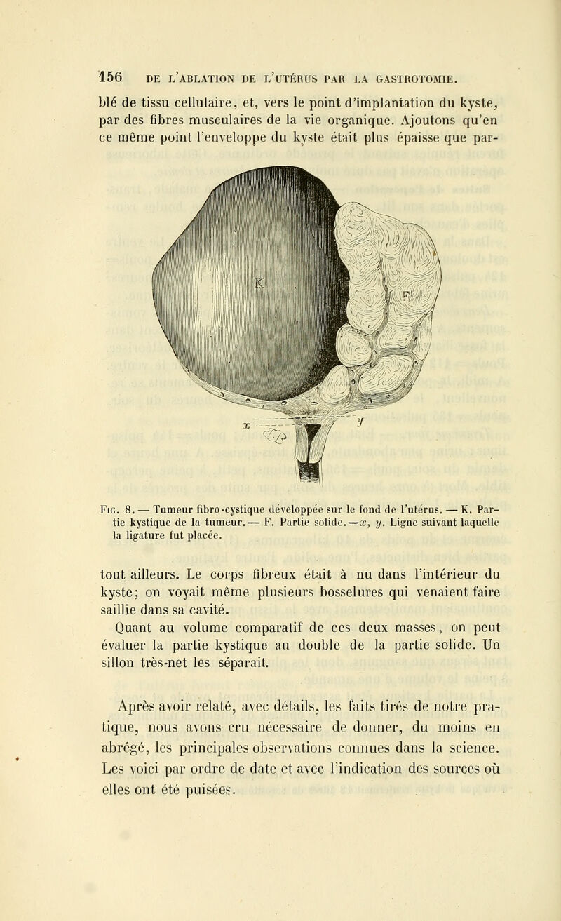 blé de tissu cellulaire, et, vers le point d'implantation du kyste, par des fibres musculaires de la vie organique. Ajoutons qu'en ce même point l'enveloppe du kyste était plus épaisse que par- Fig. 8. — Tumeur fibro-cystique développée sur le fond de l'utérus. — K. Par- tie kystique de la tumeur.— F. Partie solide.—x, y. Ligne suivant laquelle la ligature fut placée. tout ailleurs. Le corps fibreux était à nu dans l'intérieur du kyste; on voyait même plusieurs bosselures qui venaient faire saillie dans sa cavité. Quant au volume comparatif de ces deux masses, on peut évaluer la partie kystique au double de la partie solide. Un sillon très-net les séparait. Après avoir relaté, avec détails, les faits tirés de notre pra- tique, nous avons cru nécessaire de donner, du moins en abrégé, les principales observations connues dans la science. Les voici par ordre de date et avec l'indication des sources où elles ont été puisées.