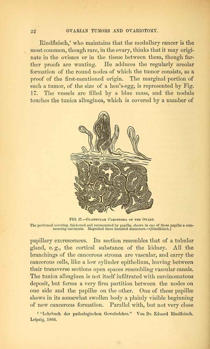 Rindfleisch,1 who maintains that the medullary cancer is the most common, though rare, in the ovary, thinks that it may origi- nate in the ovisacs or in the tissue between them, though fur- ther proofs are wanting. He adduces the regularly areolar formation of the round nodes of which the tumor consists, as a proof of the first-mentioned origin. The marginal portion of such a tumor, of the size of a hen's-egg, is represented by Fig. 17. The vessels are filled by a blue mass, and the nodule touches the tunica albuginea, which is covered by a number of FIG. 17.—Glandtjxae Carcinoma of the Ovary. The peritoneal covering, thickened and surmounted by papillae, shows in one of these papillae a com- mencing carcinosis. Magnified three hundred diameters.—(Eindfleisch.) papillary excrescences. Its section resembles that of a tubular gland, e.g., the cortical substance of the kidney. All the branchings of the cancerous stroma are vascular, and carry the cancerous cells, like a low cylinder epithelium, leaving between their transverse sections open spaces resembling vascular canals. The tunica albuginea is not itself infiltrated with carcinomatous deposit, but forms a very firm partition between the nodes on one side and the papillae on the other. One of these papillae shows in its somewhat swollen body a plainly visible beginning of new cancerous formation. Parallel with, but not very close 1 Lehrbuch der pathologischen Gewebelehre. Von Dr. Eduard Rindfleisch. Leipzig, 1866.