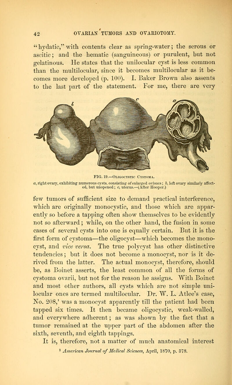  hydatic,'- with contents clear as spring-water; the serous or ascitic; and the hematic (sanguineous) or purulent, but not gelatinous. He states that the unilocular cyst is less common than the multilocular, since it becomes multilocular as it be- comes more developed (p. 100). I. Baker Brown also assents to the last part of the statement. For me, there are very FIG. 19.—Oligoctstic Cystoma. a, right ovary, exhibiting numerous cysts, consisting of enlarged ovisacs; 5, left ovary similarly affect- ed, but unopened; c, uterus.—(After Hooper.) few tumors of sufficient size to demand practical interference, which are originally monocystic, and those which are appar- ently so before a tapping often show themselves to be evidently not so afterward; while, on the other hand, the fusion in some cases of several cysts into one is equally certain. But it is the first form of cystoma—the oligocyst—which becomes the mono- cyst, and vice versa. The true polycyst has other distinctive tendencies; but it does not become a monocyst, nor is it de- rived from the latter. The actual monocyst, therefore, should be, as Boinet asserts, the least common of all the forms of cystoma ovarii, but not for the reason he assigns. With Boinet and most other authors, all cysts which are not simple uni- locular ones are termed multilocular. Dr. W. L. Atlee's case, No. 208/ was a monocyst apparently till the patient had been tapped six times. It then became oligocystic, weak-walled, and everywhere adherent; as was shown by the fact that a tumor remained at the upper part of the abdomen after the sixth, seventh, and eighth tappings. It is, therefore, not a matter of much anatomical interest