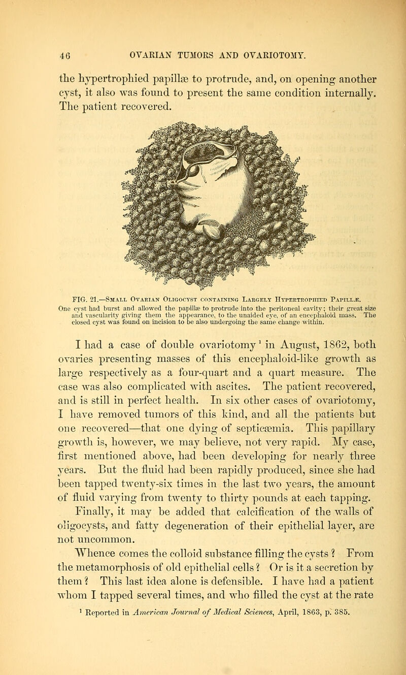 the hypertrophied papillae to protrude, and, on opening another cyst, it also was found to present the same condition internally. The patient recovered. FIG. 21.—Small Ovarian Oligocyst containing Largely Hypertrophied Papilla. One cyst had burst and allowed the papilla; to protrude into the peritoneal cavity; their great size and vascularity giving them the appearance, to the unaided eye, of an encephaloid mass. The closed cyst was found on incision to be also undergoing the same change within. I had a case of double ovariotomy1 in August, 1862, both ovaries presenting masses of this encephaloid-like growth as large respectively as a four-quart and a quart measure. The case was also complicated with ascites. The patient recovered, and is still in perfect health. In six other cases of ovariotomy, I have removed tumors of this kind, and all the patients but one recovered—that one dying of septicaemia. This papillary growth is, however, we may believe, not very rapid. My case, first mentioned above, had been developing for nearly three years. But the fluid had been rapidly produced, since she had been tapped twenty-six times in the last two years, the amount of fluid varying from twenty to thirty pounds at each tapping. Finally, it may be added that calcification of the walls of oligocysts, and fatty degeneration of their epithelial layer, are not uncommon. Whence comes the colloid substance filling the cysts ? From the metamorphosis of old epithelial cells ? Or is it a secretion by them % This last idea alone is defensible. I have had a patient whom I tapped several times, and who filled the cyst at the rate